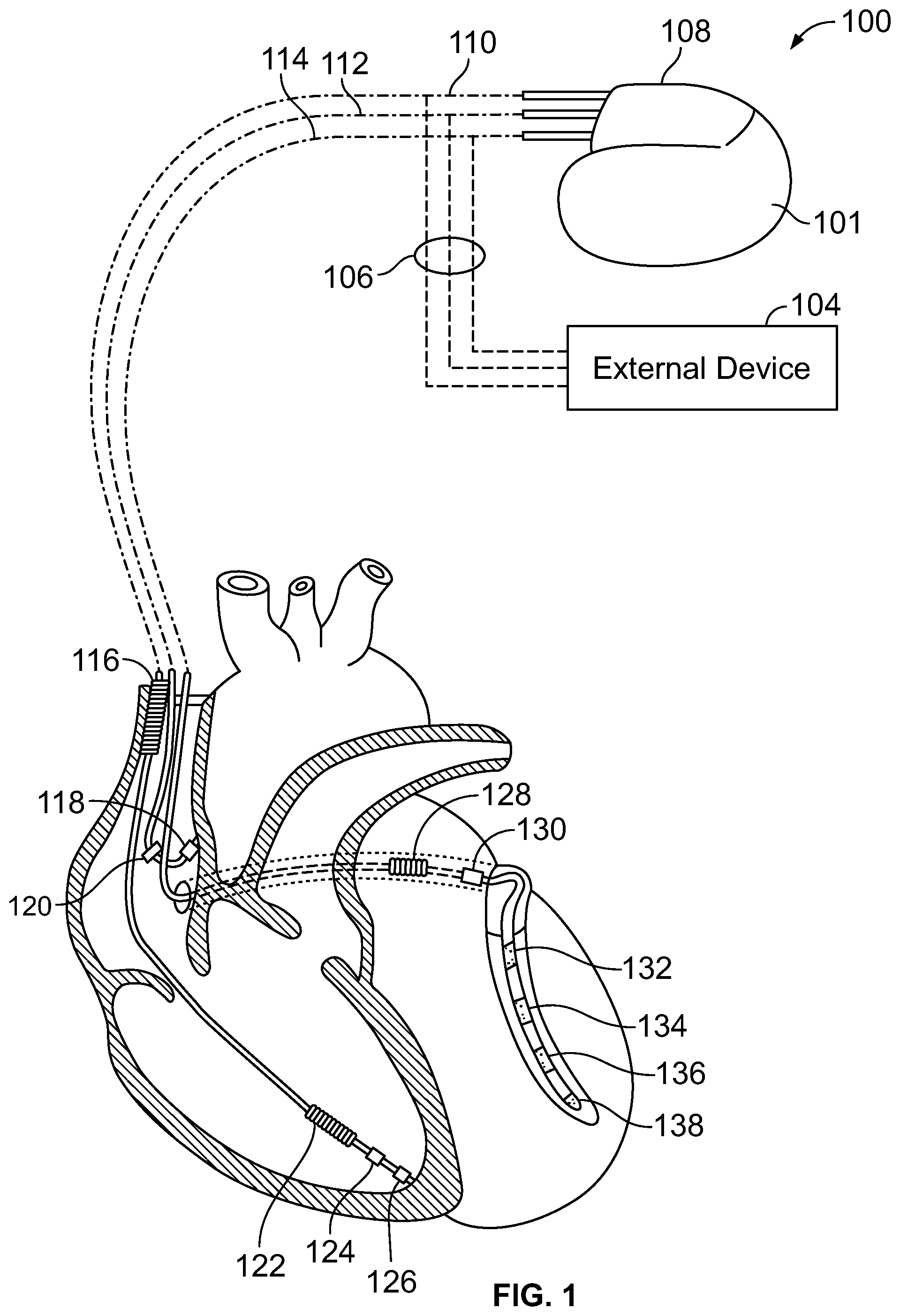 Patent US12303699 — Method and device for avoiding competitive atrial pacing — Figure 1