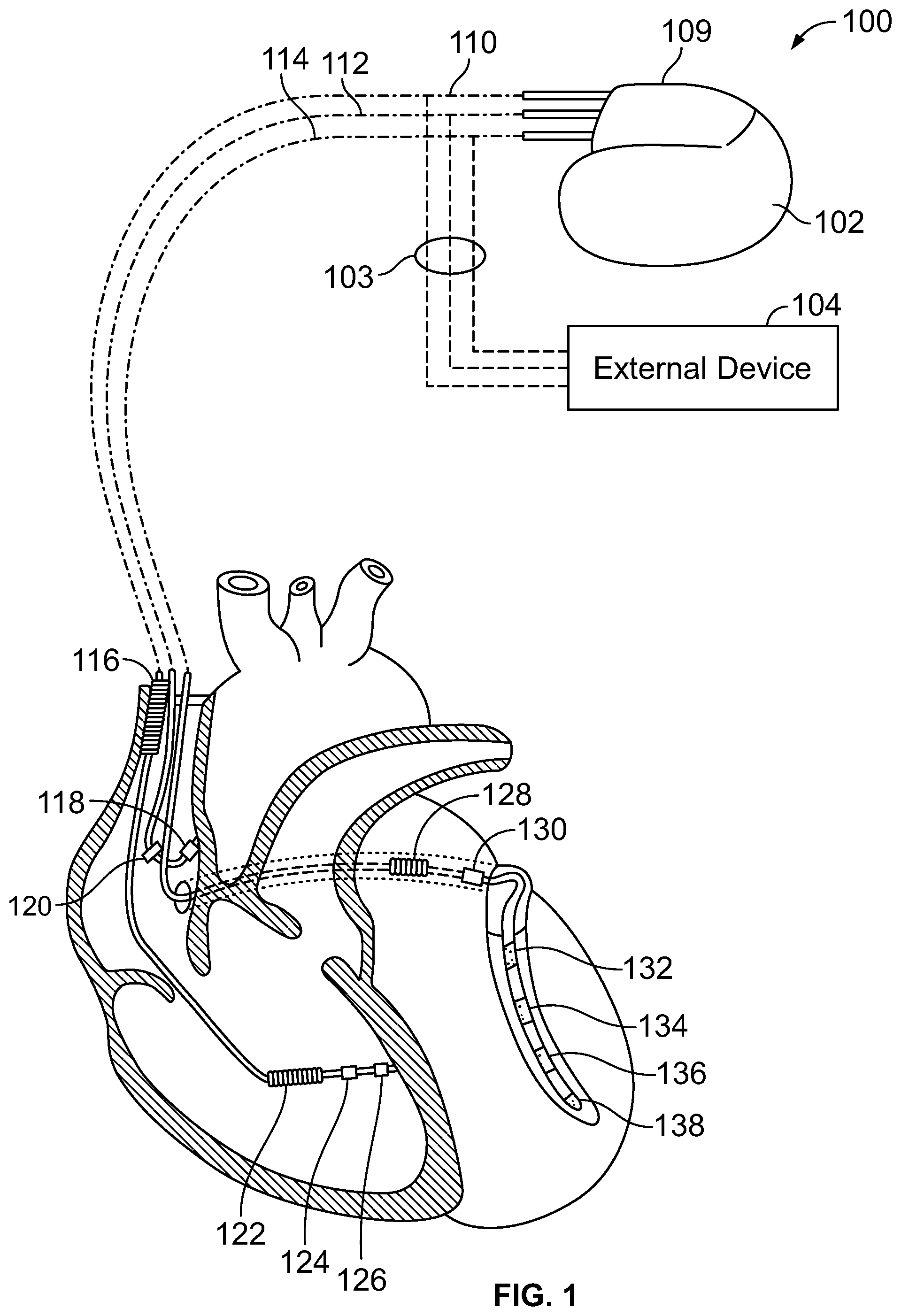 Patent US12303700 — Method and system for implanting a septal wall electrode — Figure 1
