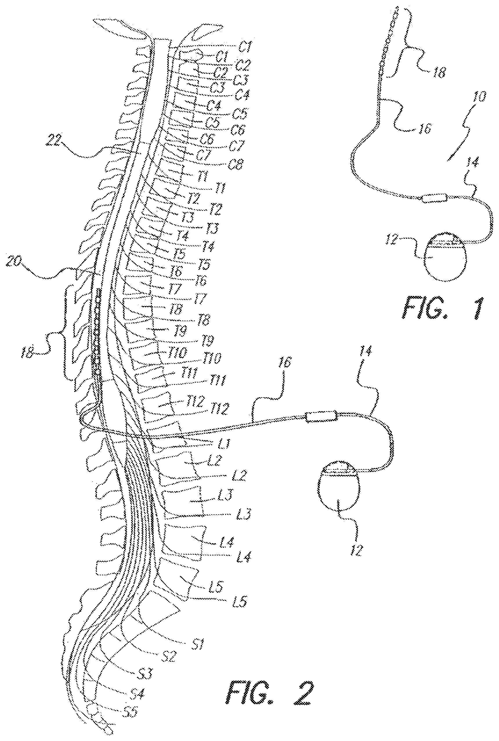 Patent US12303702 — Automatic adjustment to maintain evoked potential feature — Figure 1