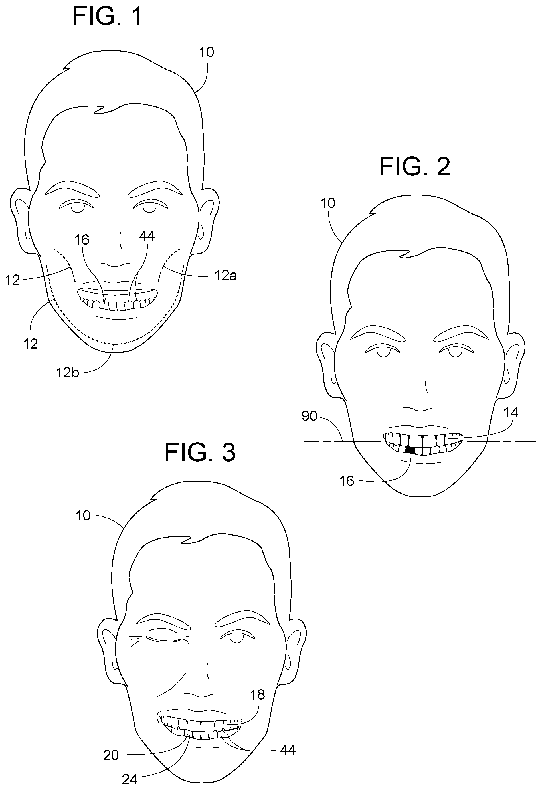 Patent US12307656 Figure 1 – Computer assisted dental methods for analyzing jaws