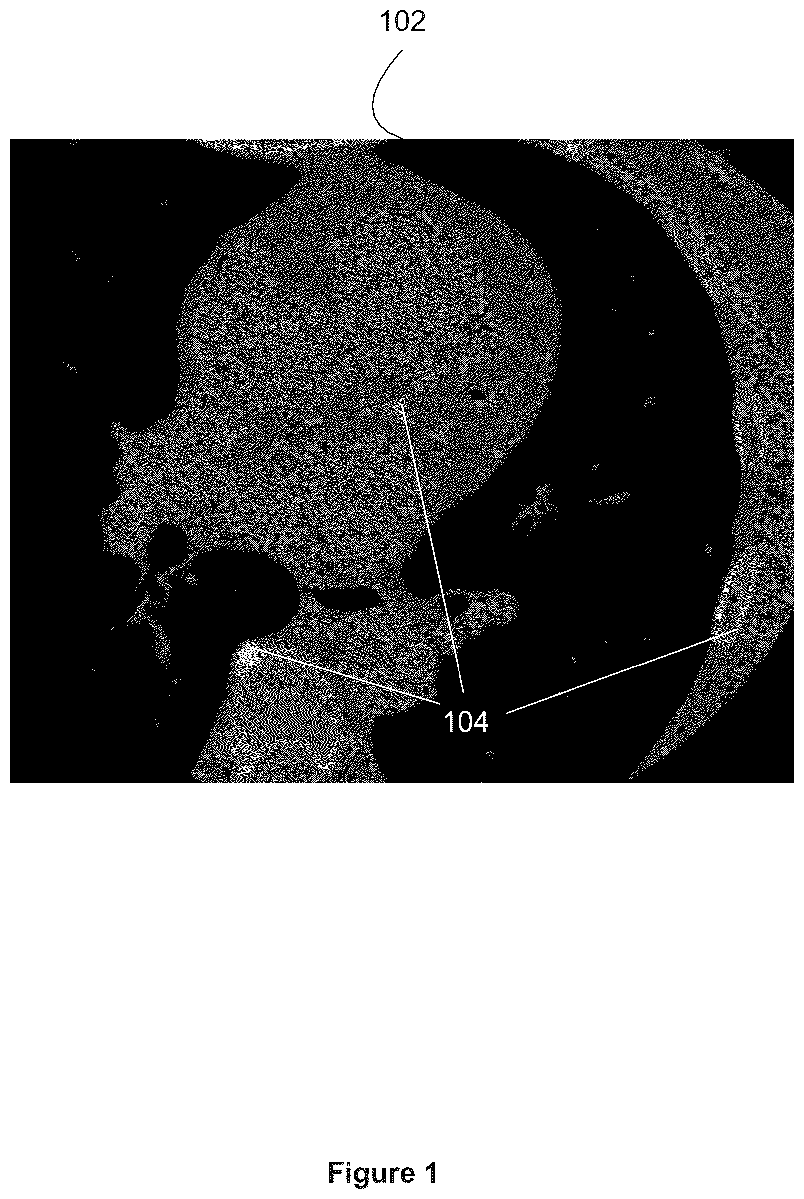 Patent US12307660 — Method and system for automatic calcium scoring from medical images — Figure 1