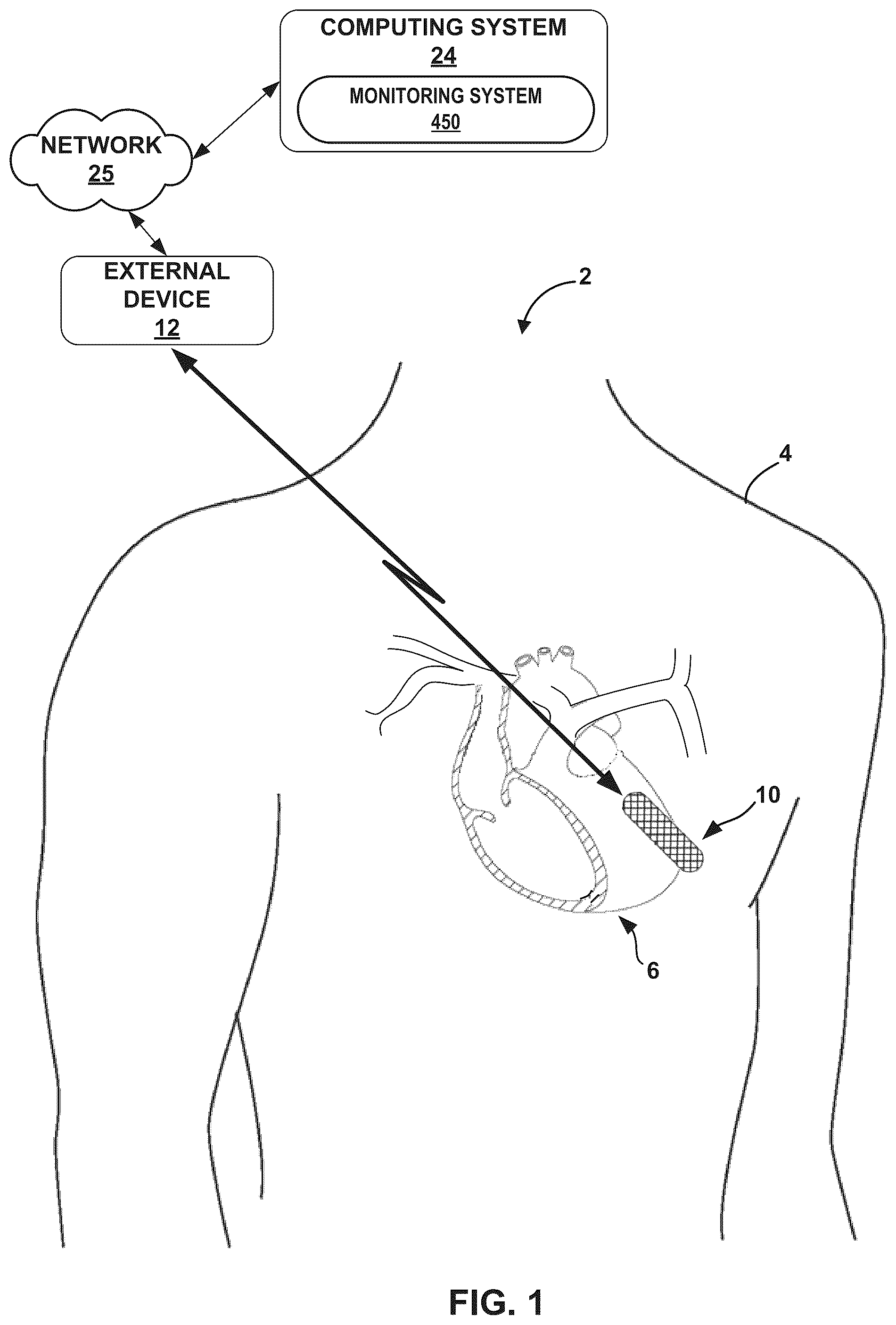 Patent US12308121 Figure 1 – Machine learning based depolarization identification and arrhythmia localization visualization