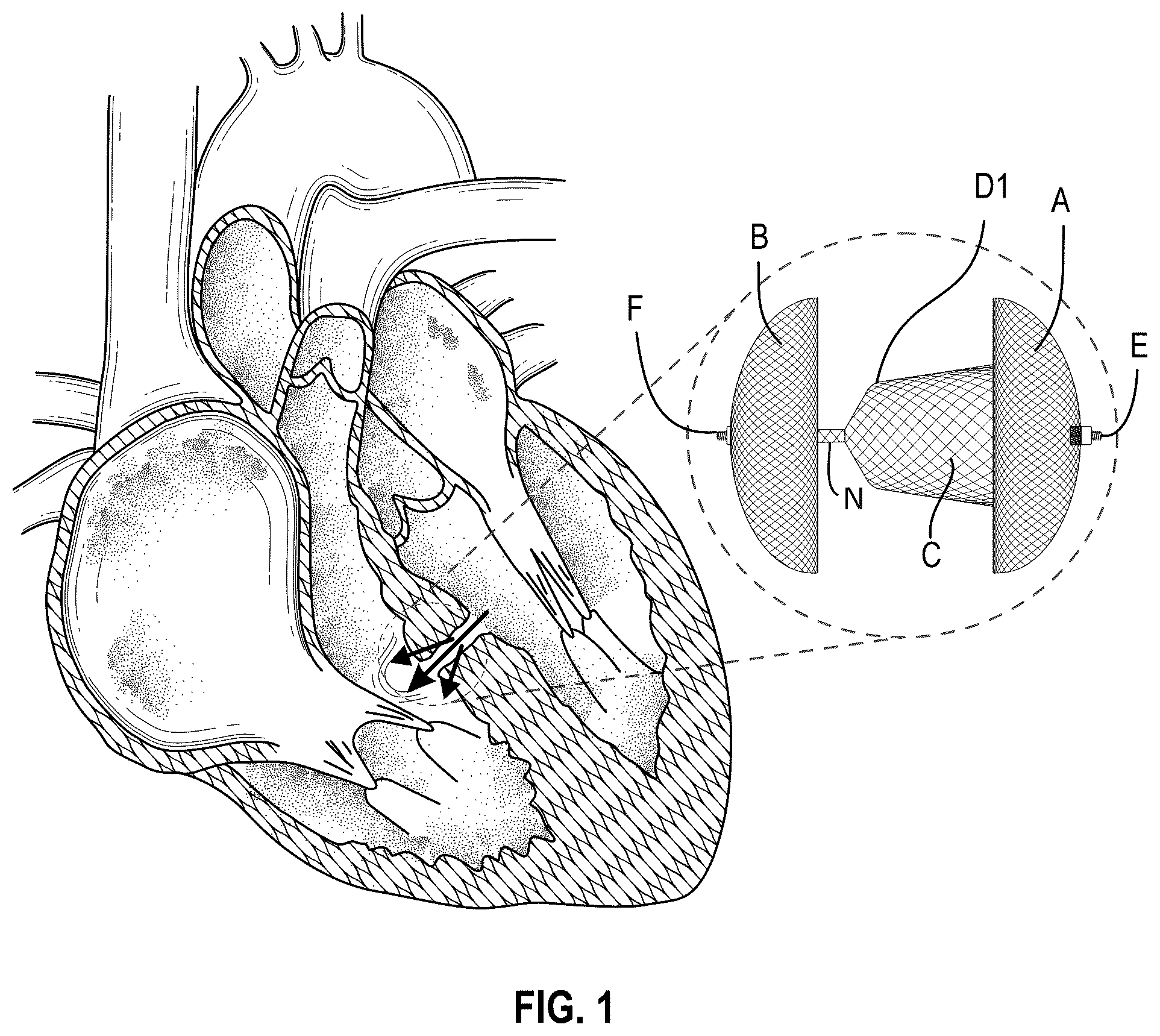 Patent US12310568 Figure 1 – Multi-functional occluder
