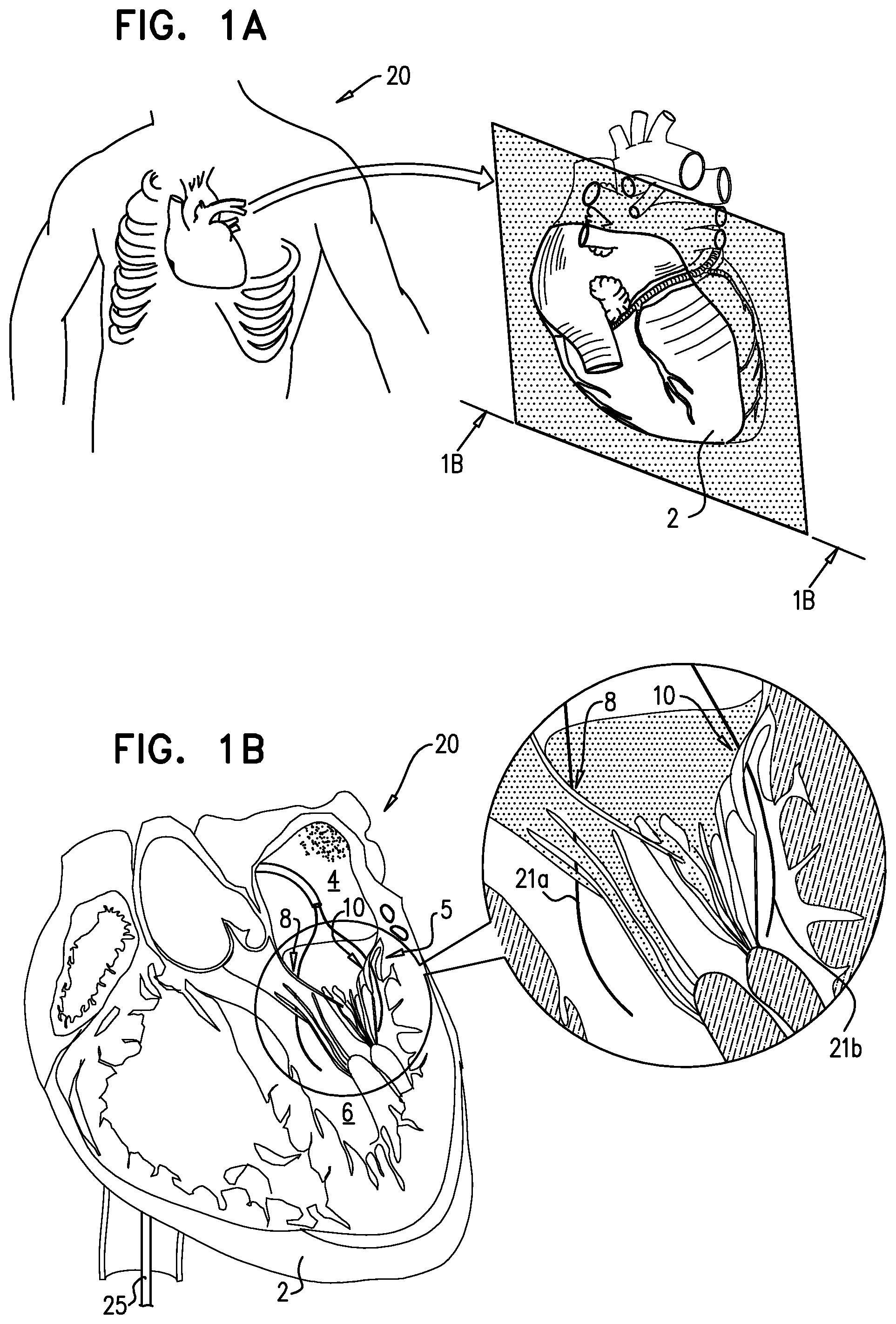 Patent US12310575 — Helical anchor implantation — Figure 1