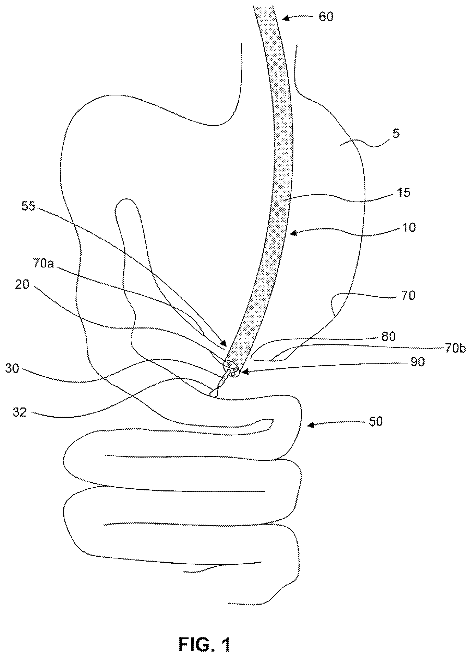 Patent US12310588 — Devices for approximating tissue and related methods of use — Figure 1