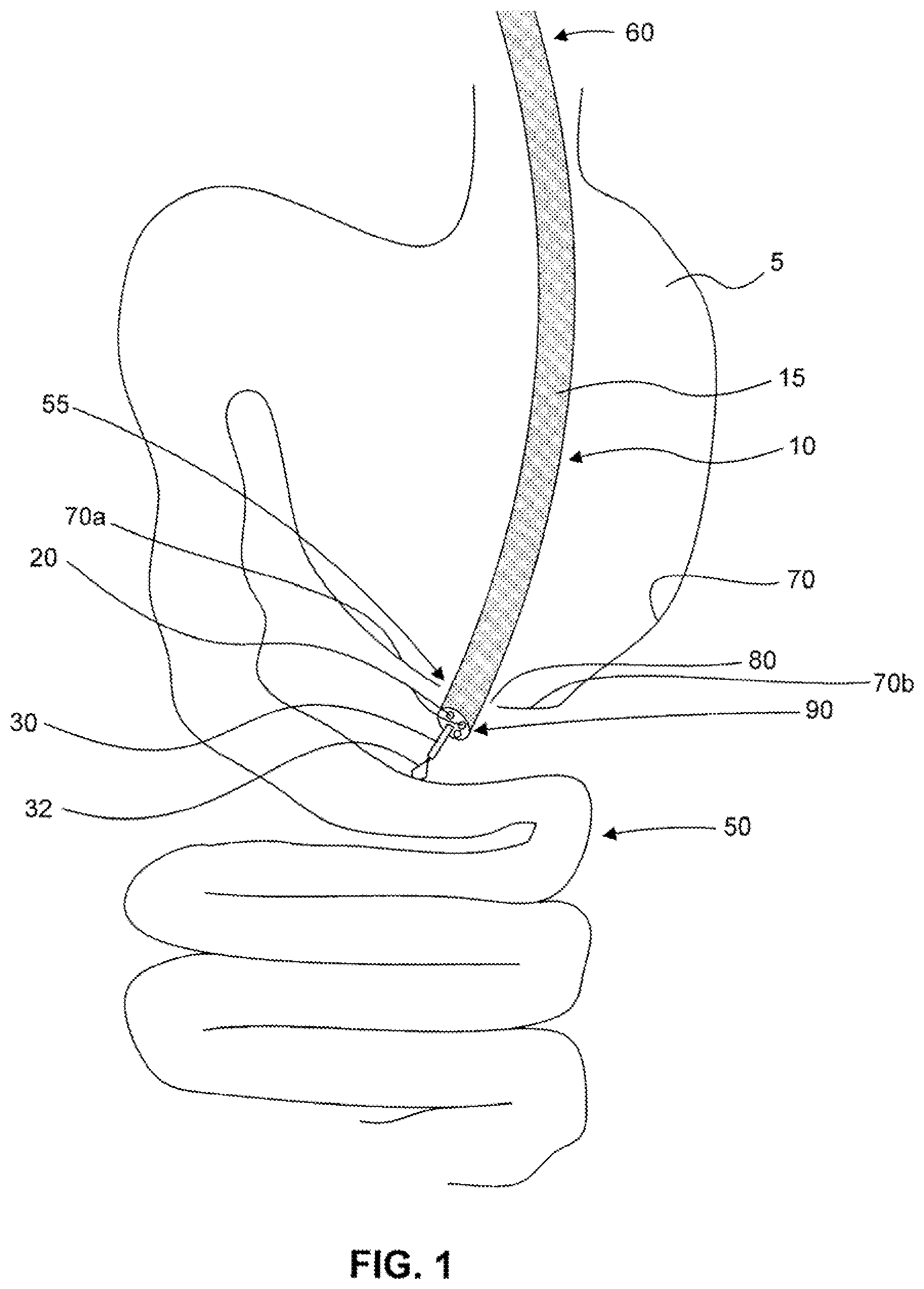 Patent US12310589 Figure 1 – Devices for approximating tissue and related methods of use