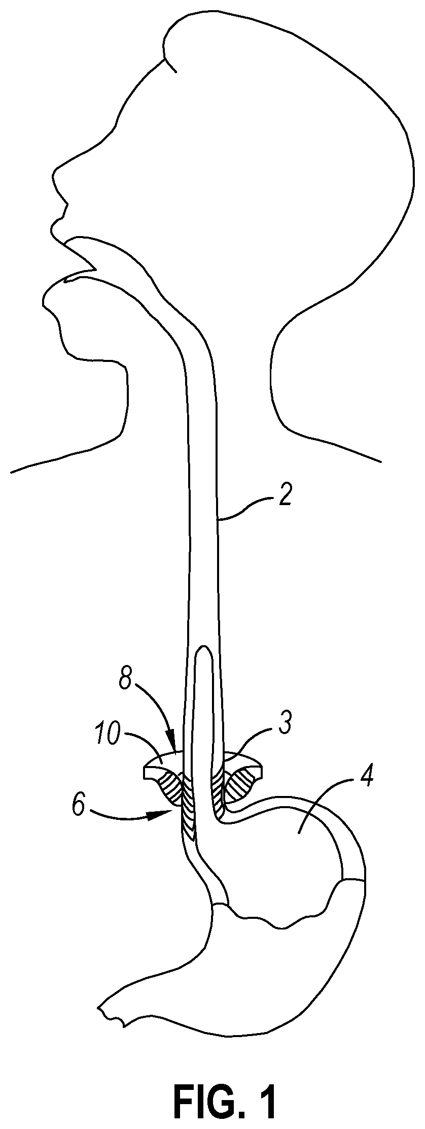 Patent US12310593 Figure 1 – Implantable sphincter device with bead orientation control based on bead interactive geometry