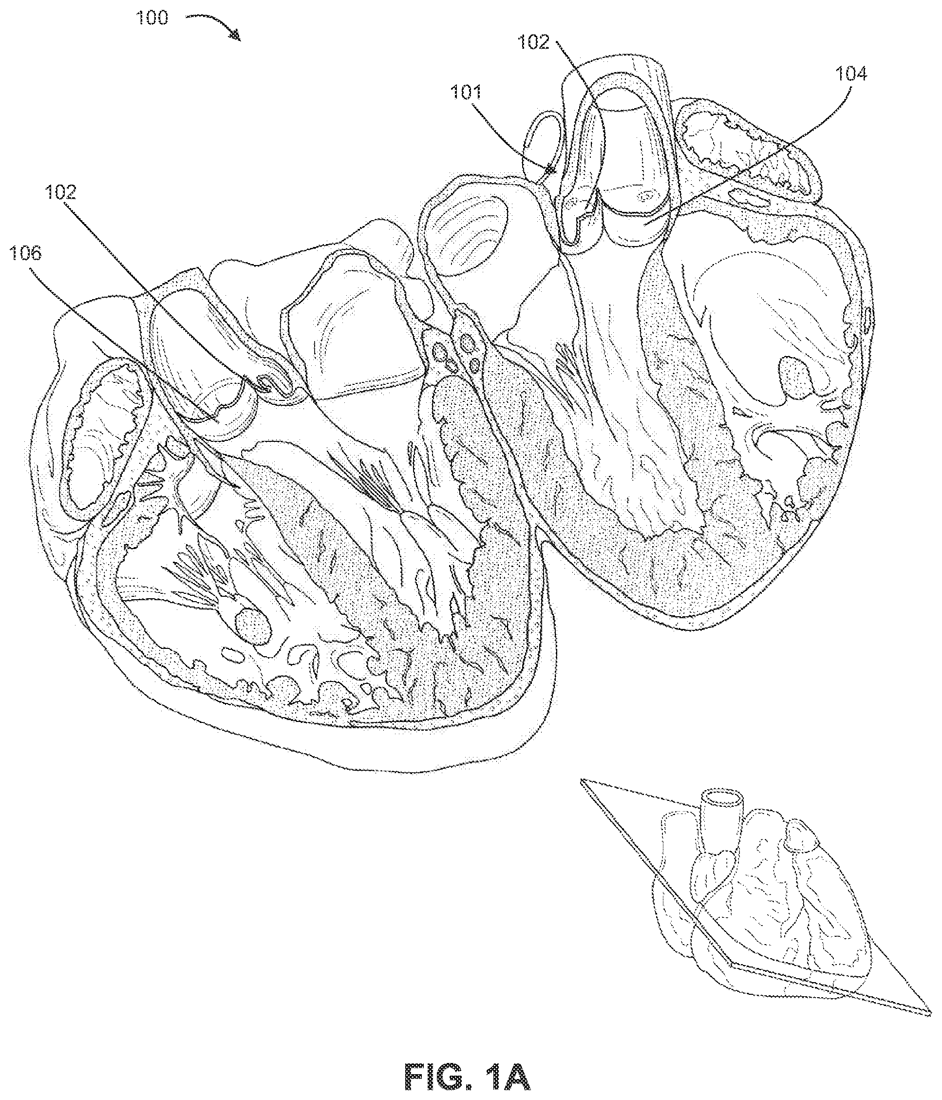 Patent US12310605 — Shock wave valvuloplasty with multiple balloons — Figure 1