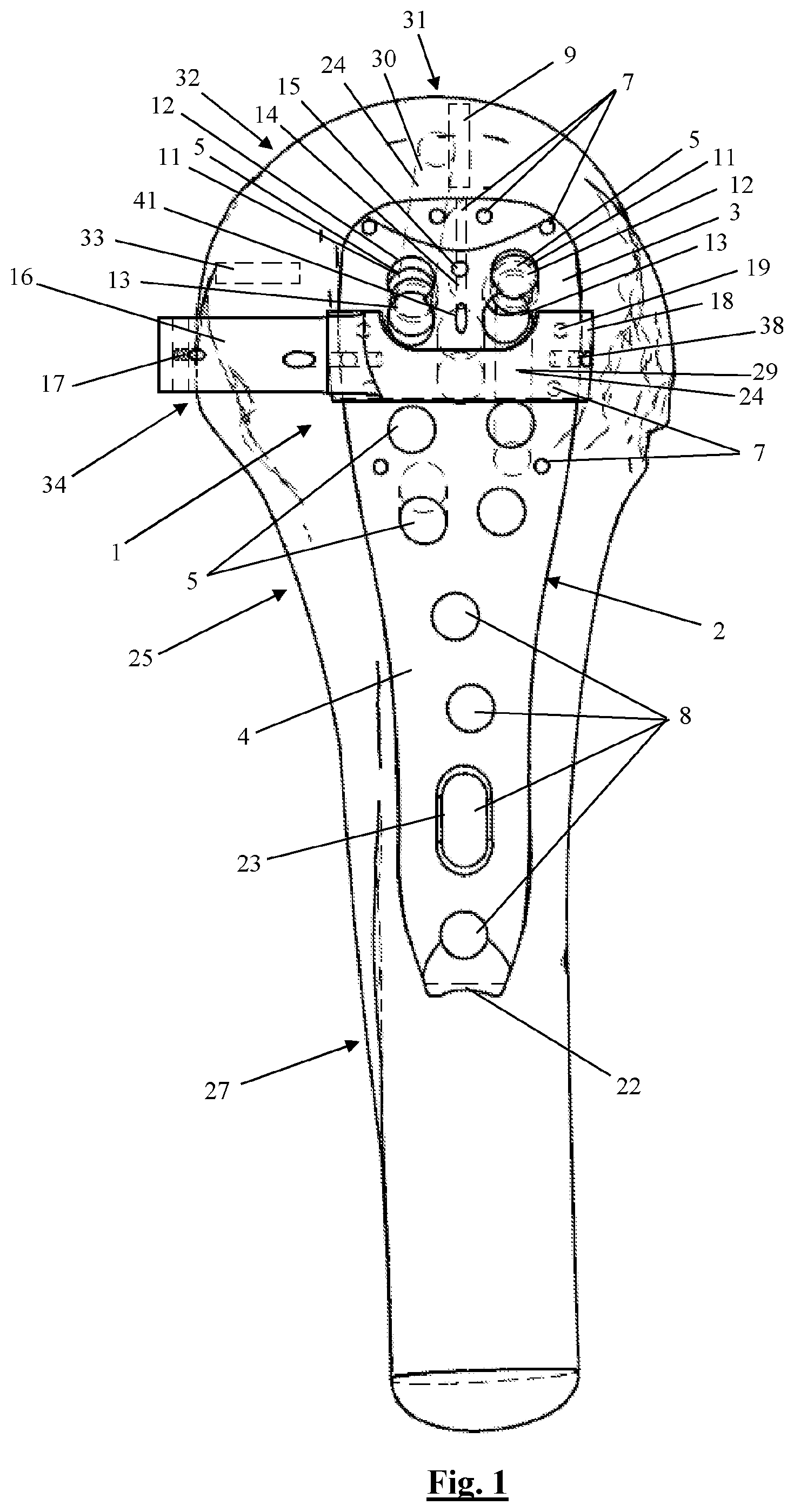 Patent US12310628 — Proximal humeral fixation plate and method for placing such a fixation plate — Figure 1