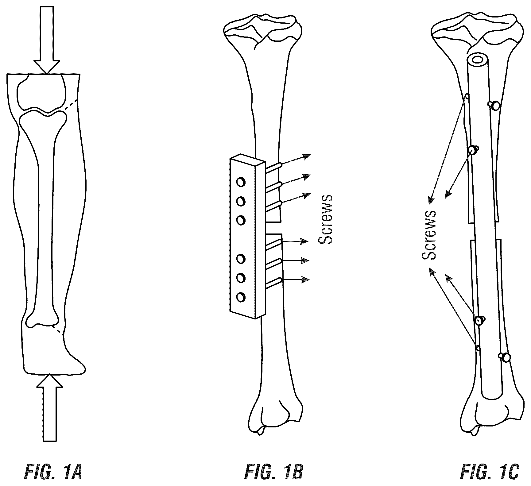 Patent US12310635 — Tunable stiffness bone rod — Figure 1