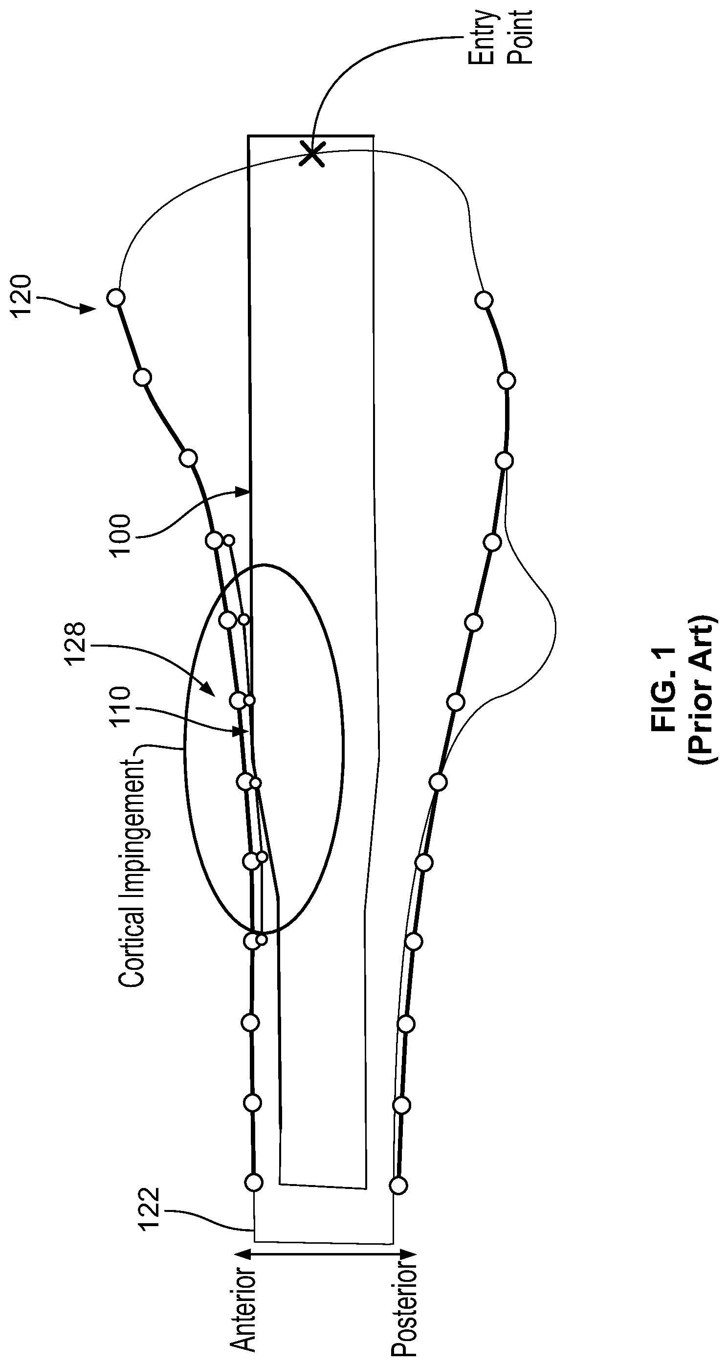 Patent US12310636 Figure 1 – Femoral nail with enhanced bone conforming geometry