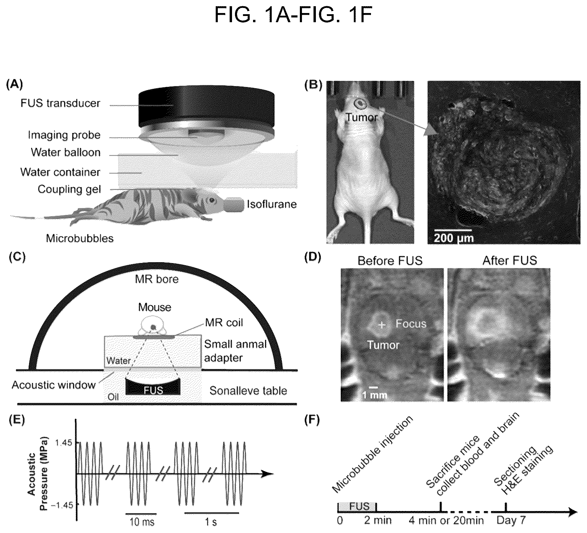 Patent US12310697 Figure 1 – Methods and systems for noninvasive and localized brain liquid biopsy using focused ultrasound