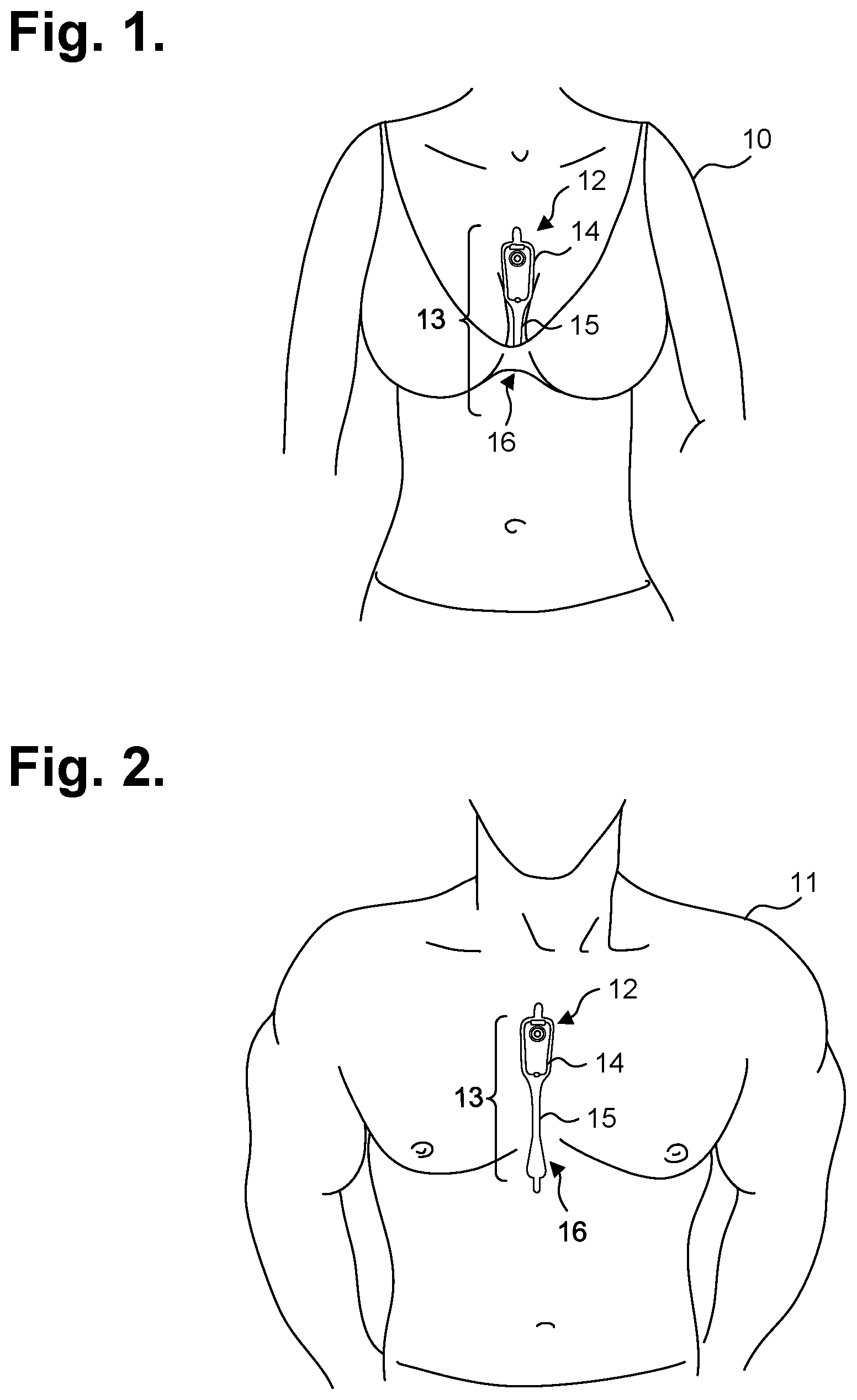 Patent US12310735 — Extended wear ambulatory electrocardiography monitor — Figure 1
