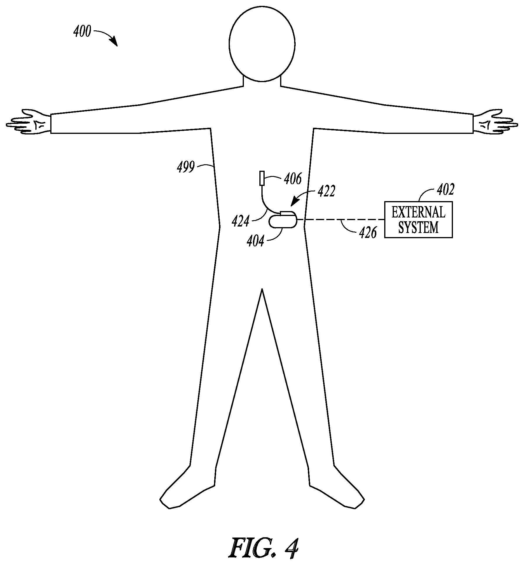 Patent US12310738 Figure 3 – Stimulation progamming aid using a sensory projection