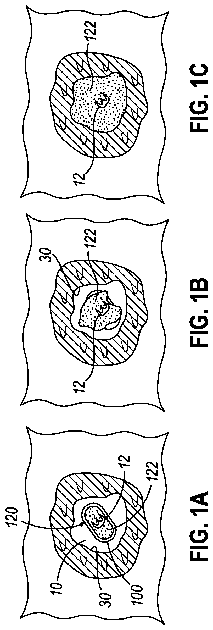 Patent US12310801 — Apparatus for delivering biopsy cavity marker — Figure 1