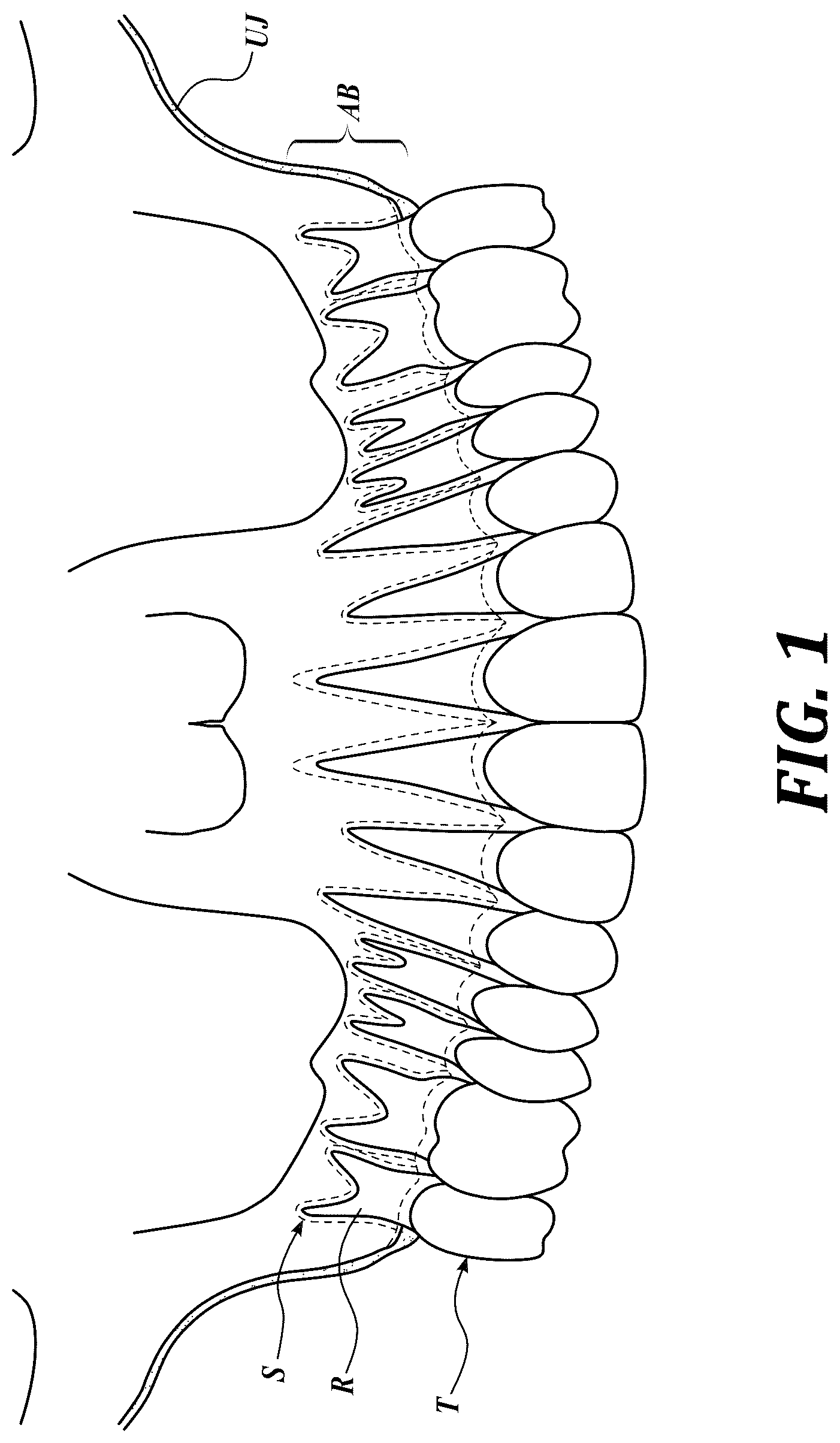 Patent US12310818 — Process for preparing a patient's jaw for a full arch teeth replacement — Figure 1