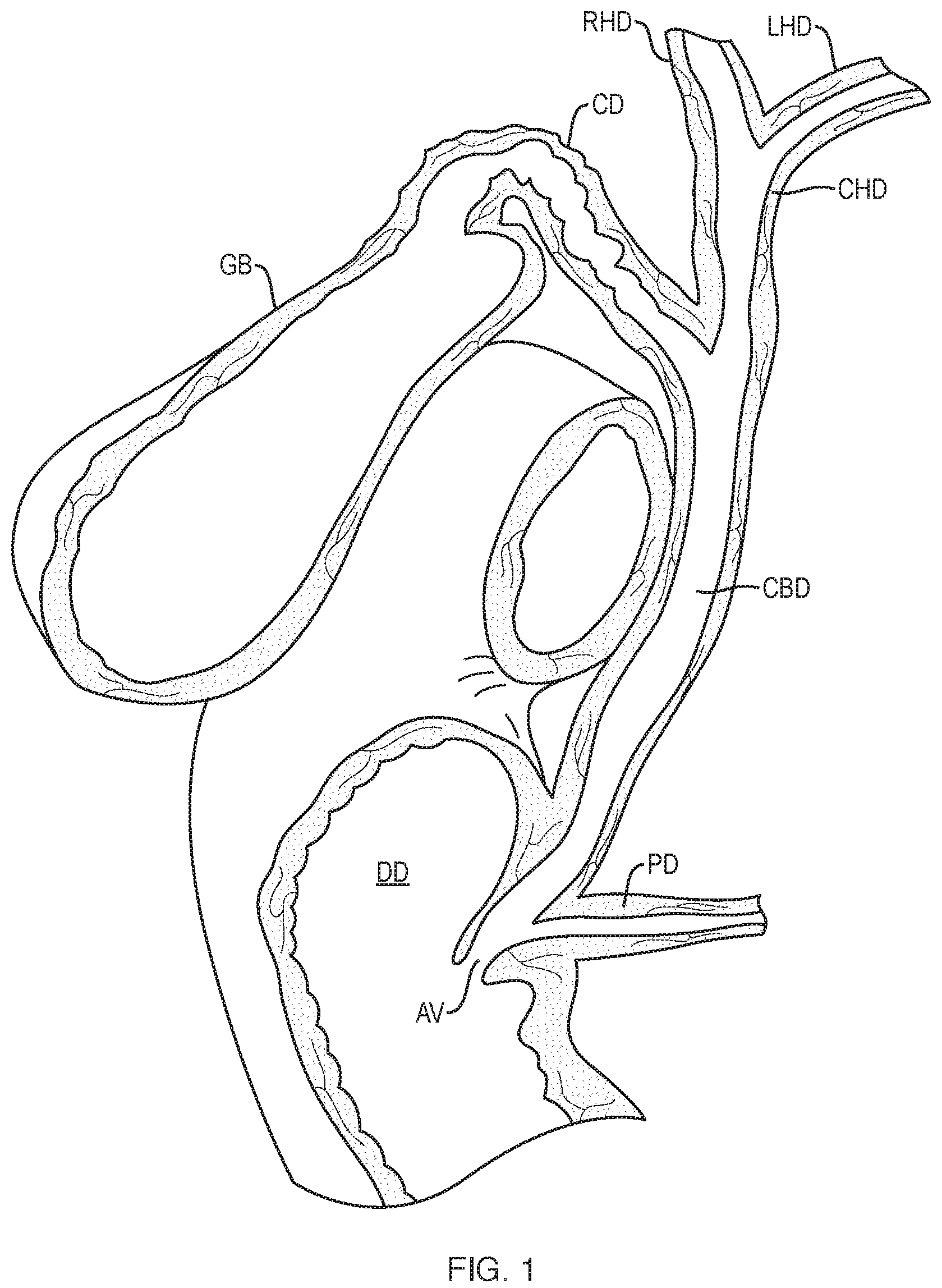 Patent US12310832 — Biliary stents and methods — Figure 1