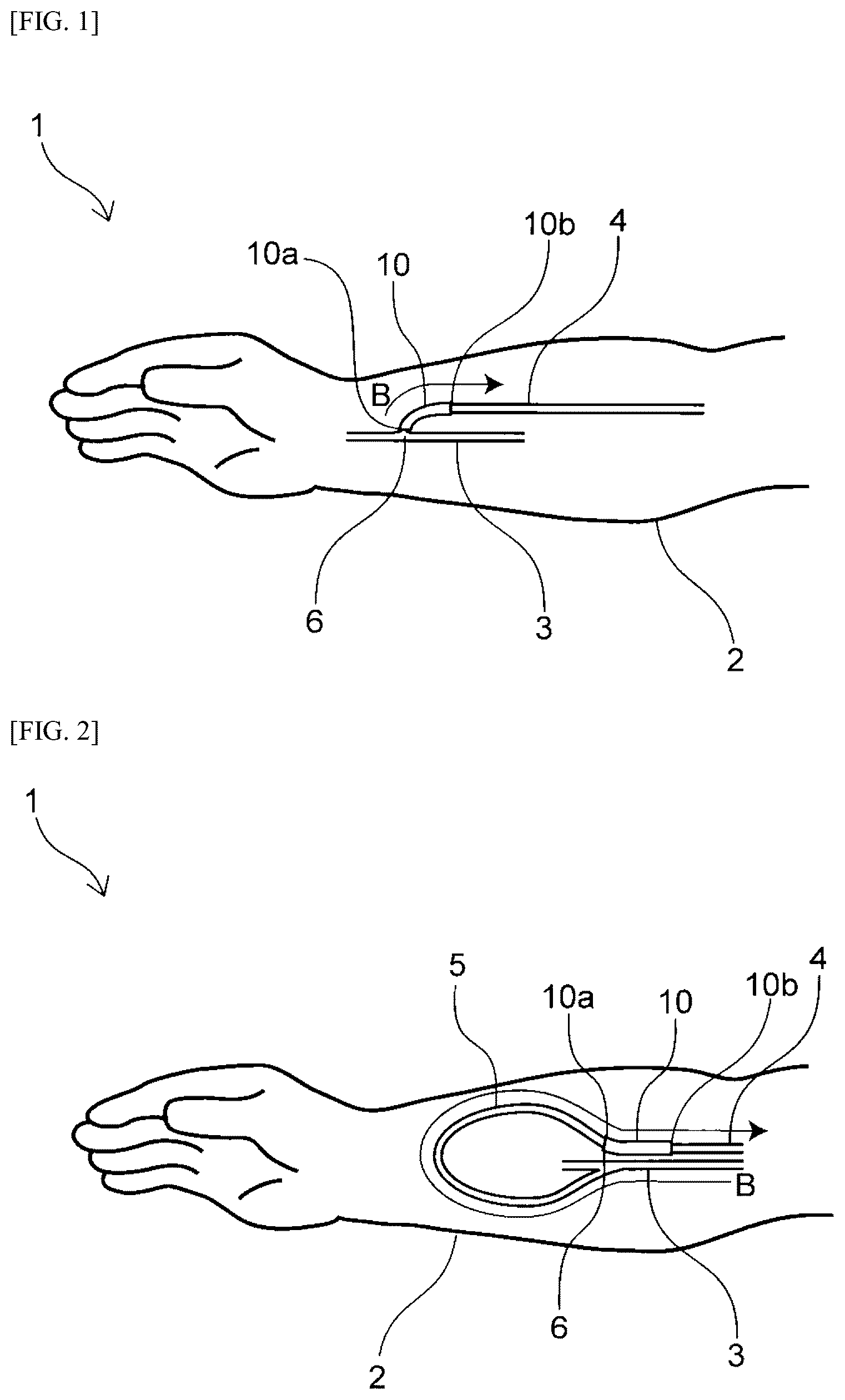 Patent US12310836 — Vein cover — Figure 1