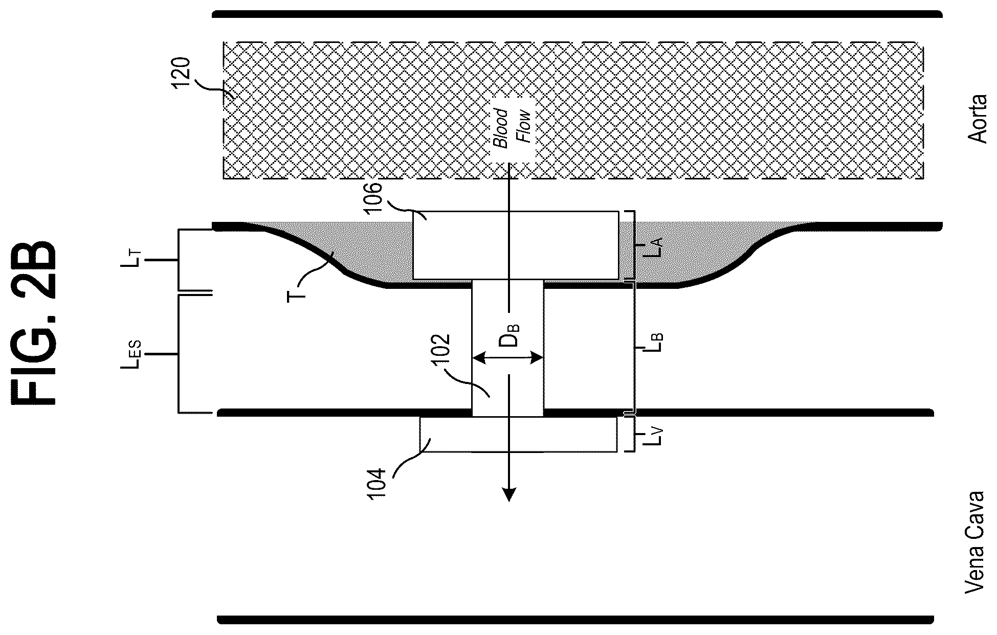 Patent US12310837 Figure 4 – Methods and systems for transcaval treatment of aneurysms