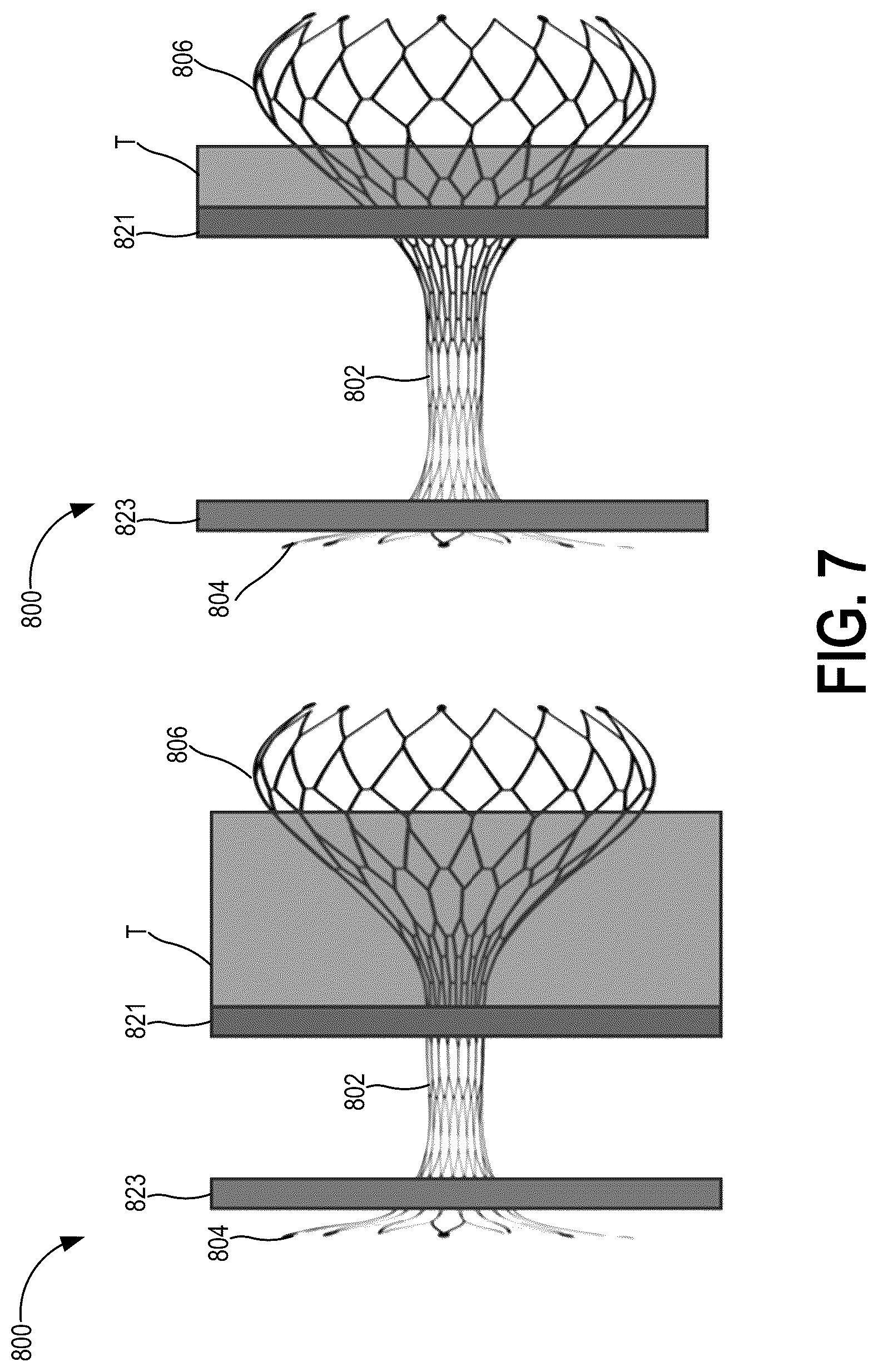 Patent US12310837 Figure 13 – Methods and systems for transcaval treatment of aneurysms