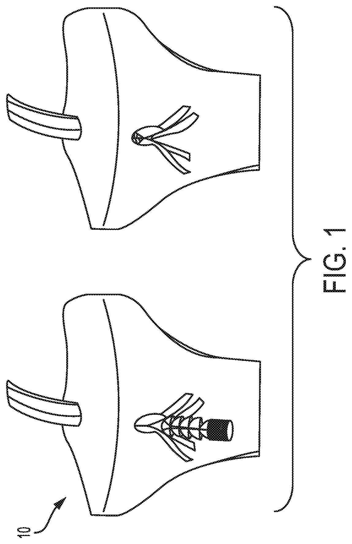 Patent US12310839 — Expanding anchor — Figure 1
