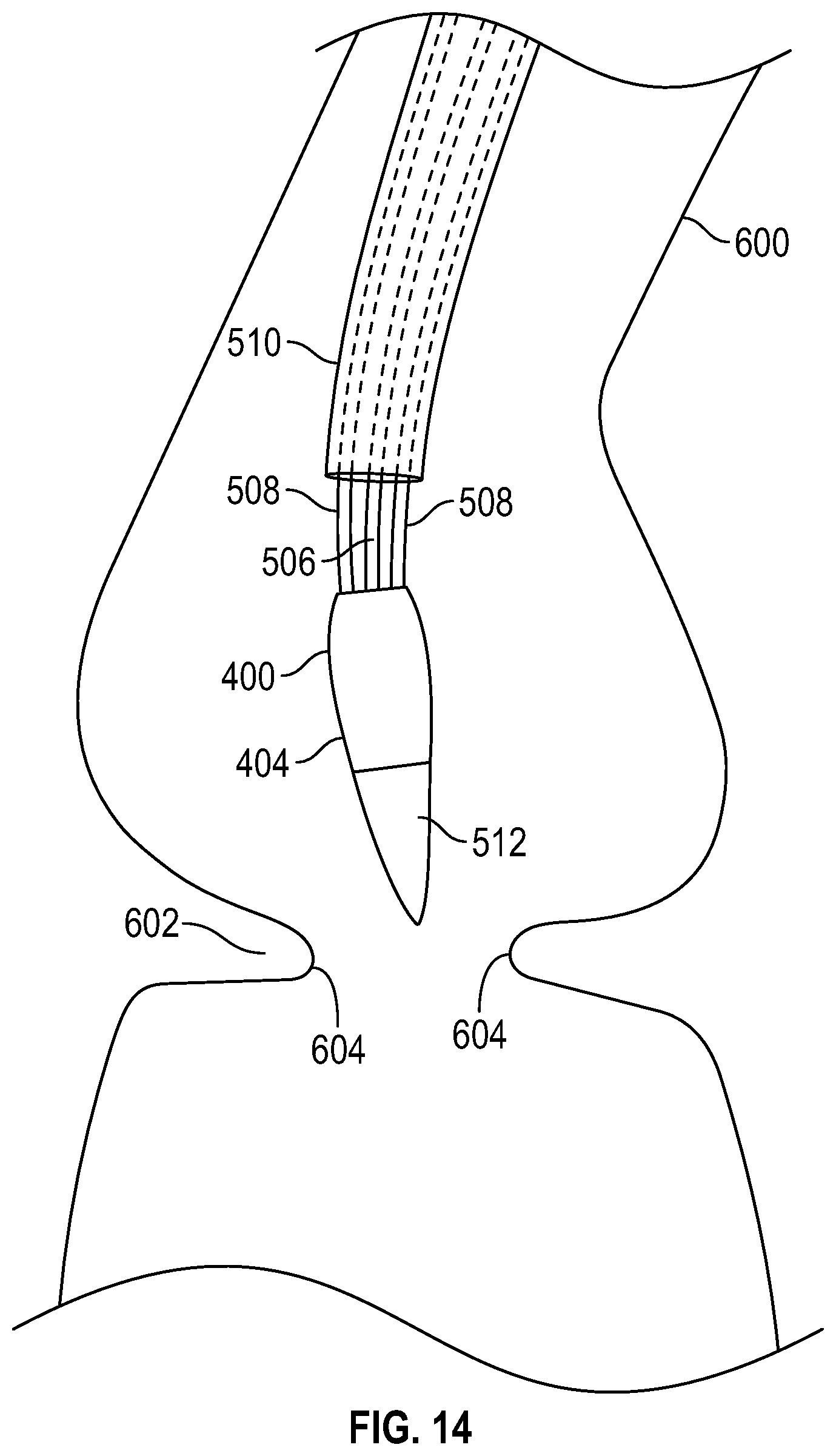 Patent US12310847 Figure 11 – Prosthetic heart valve having non-cylindrical frame