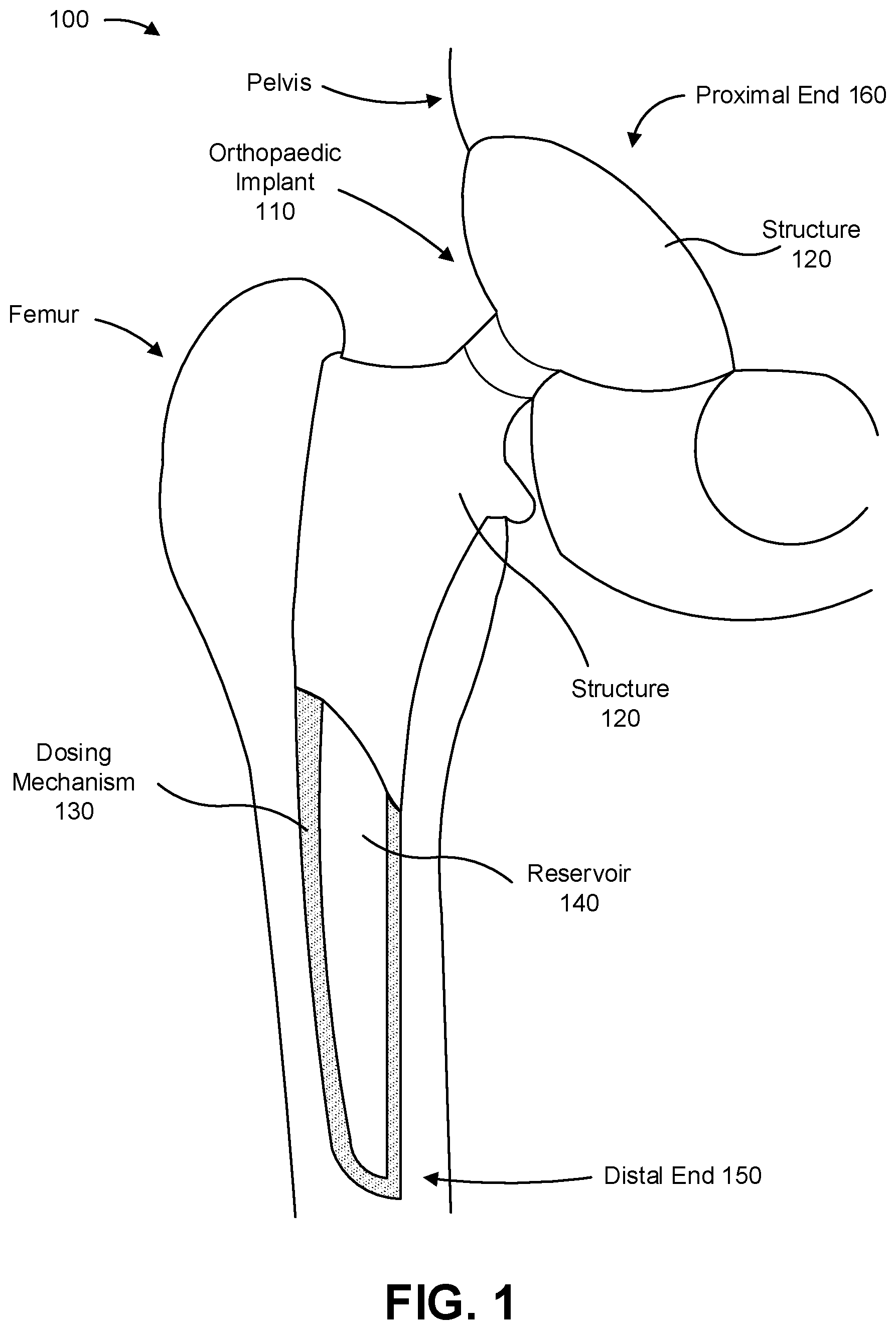 Patent US12310854 Figure 1 – Orthopaedic implant to administer a medical substance