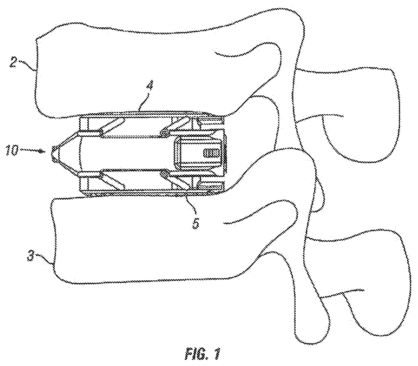 Patent US12310860 — Expandable fusion device and method of installation thereof — Figure 1