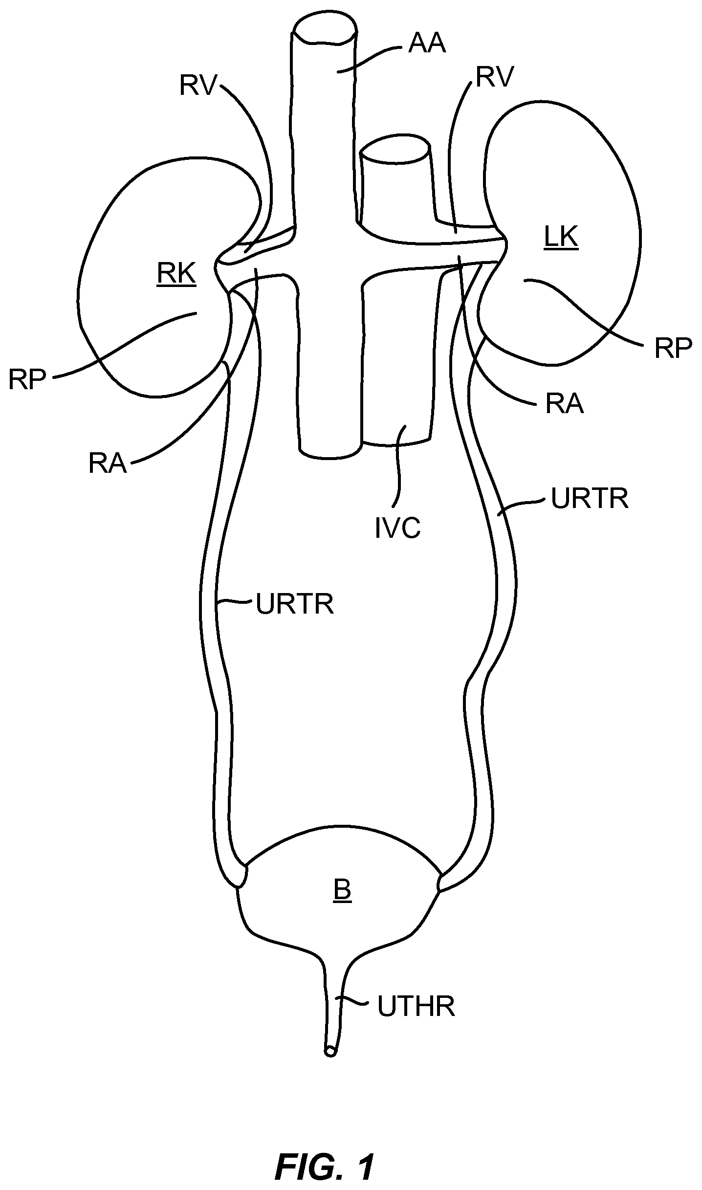 Patent US12310927 — Methods and systems for ablation of the renal pelvis — Figure 1
