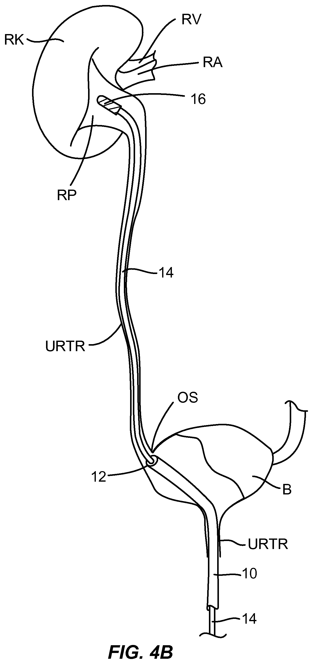 Patent US12310927 Figure 6 – Methods and systems for ablation of the renal pelvis