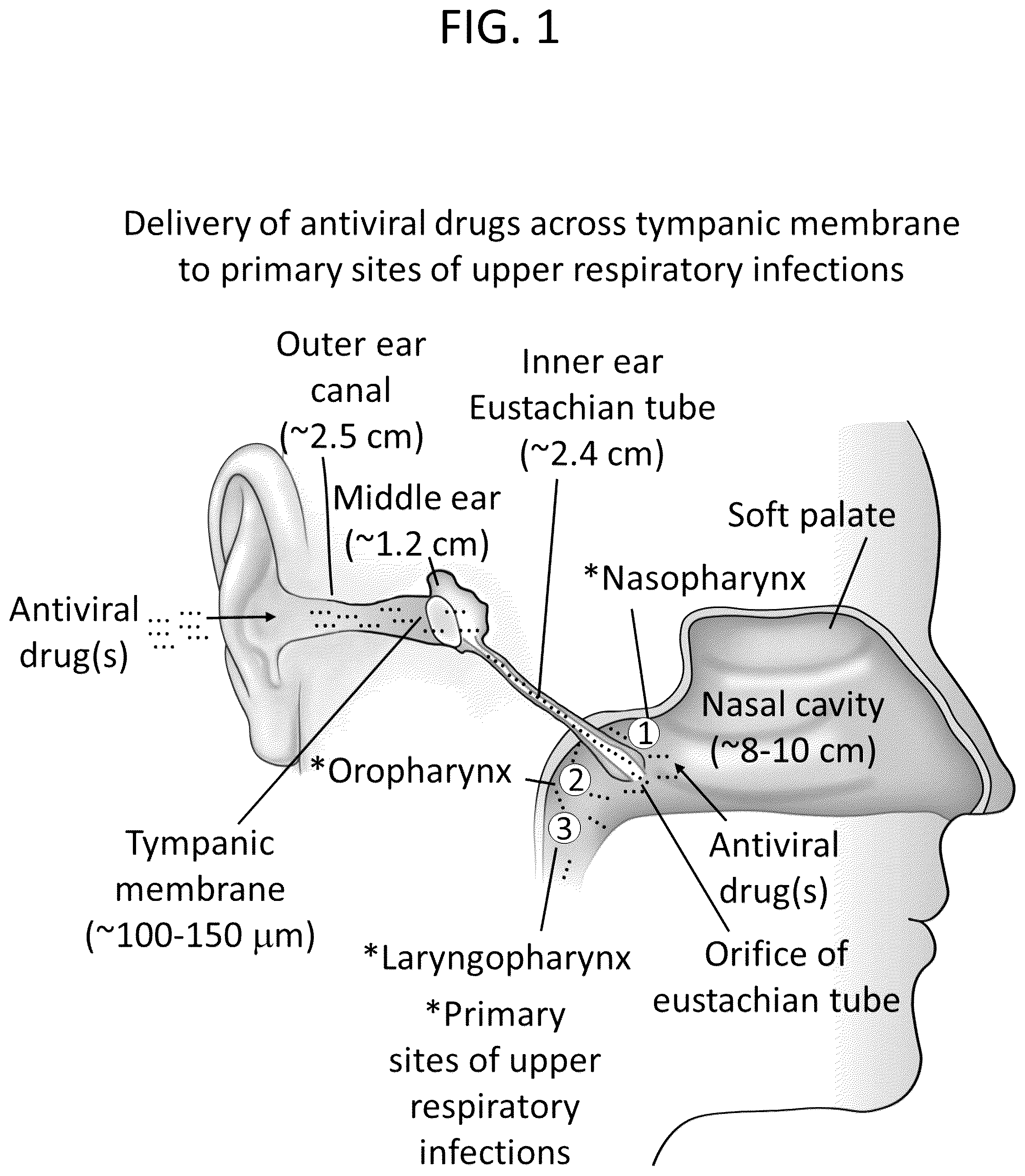 Patent US12311049 Figure 1 – Formulation of ear drops and methods for delivery thereof for treating upper respiratory infections
