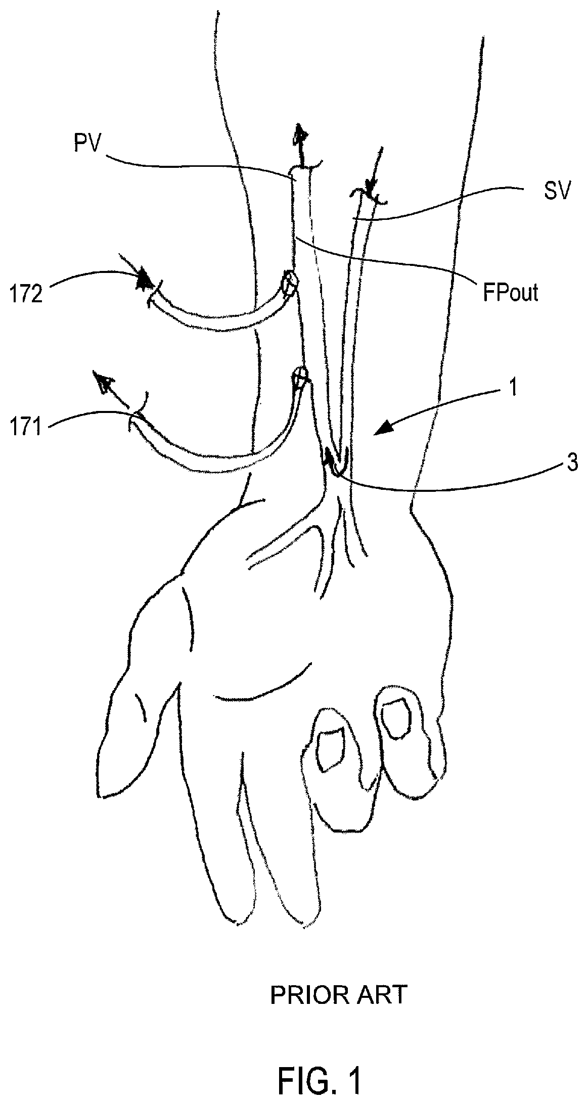Patent US12311092 — Vascular flow control devices and methods — Figure 1