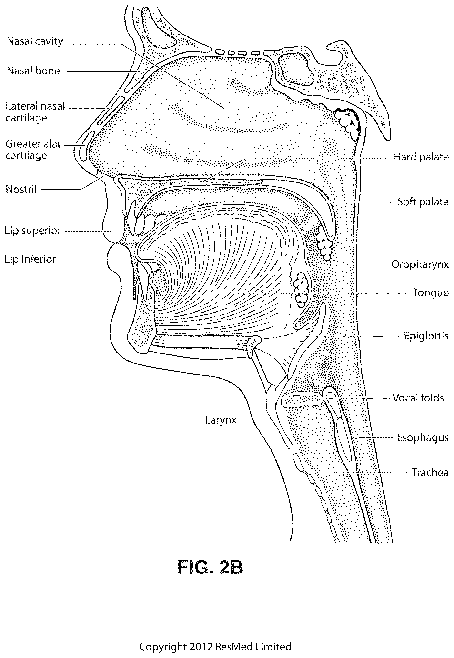 Patent US12311108 Figure 5 – Conduit headgear connector for patient interface