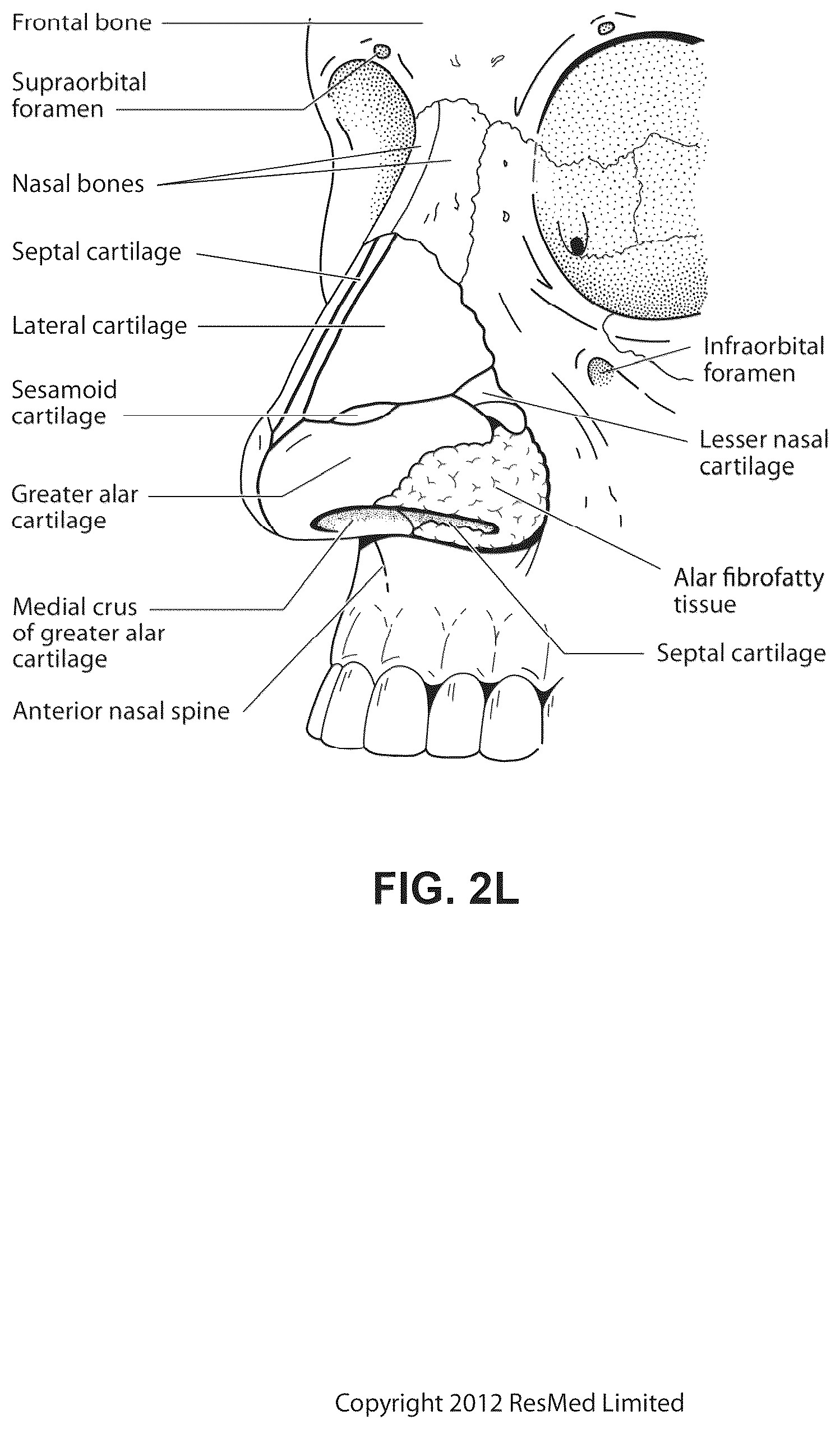 Patent US12311108 Figure 12 – Conduit headgear connector for patient interface