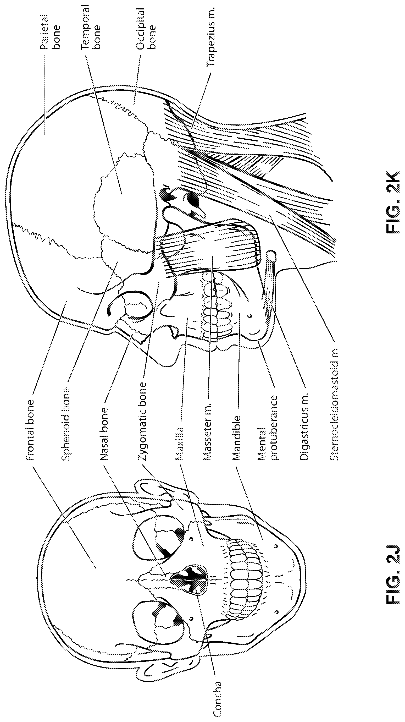 Patent US12311111 Figure 11 – Vent adaptor for a respiratory therapy system