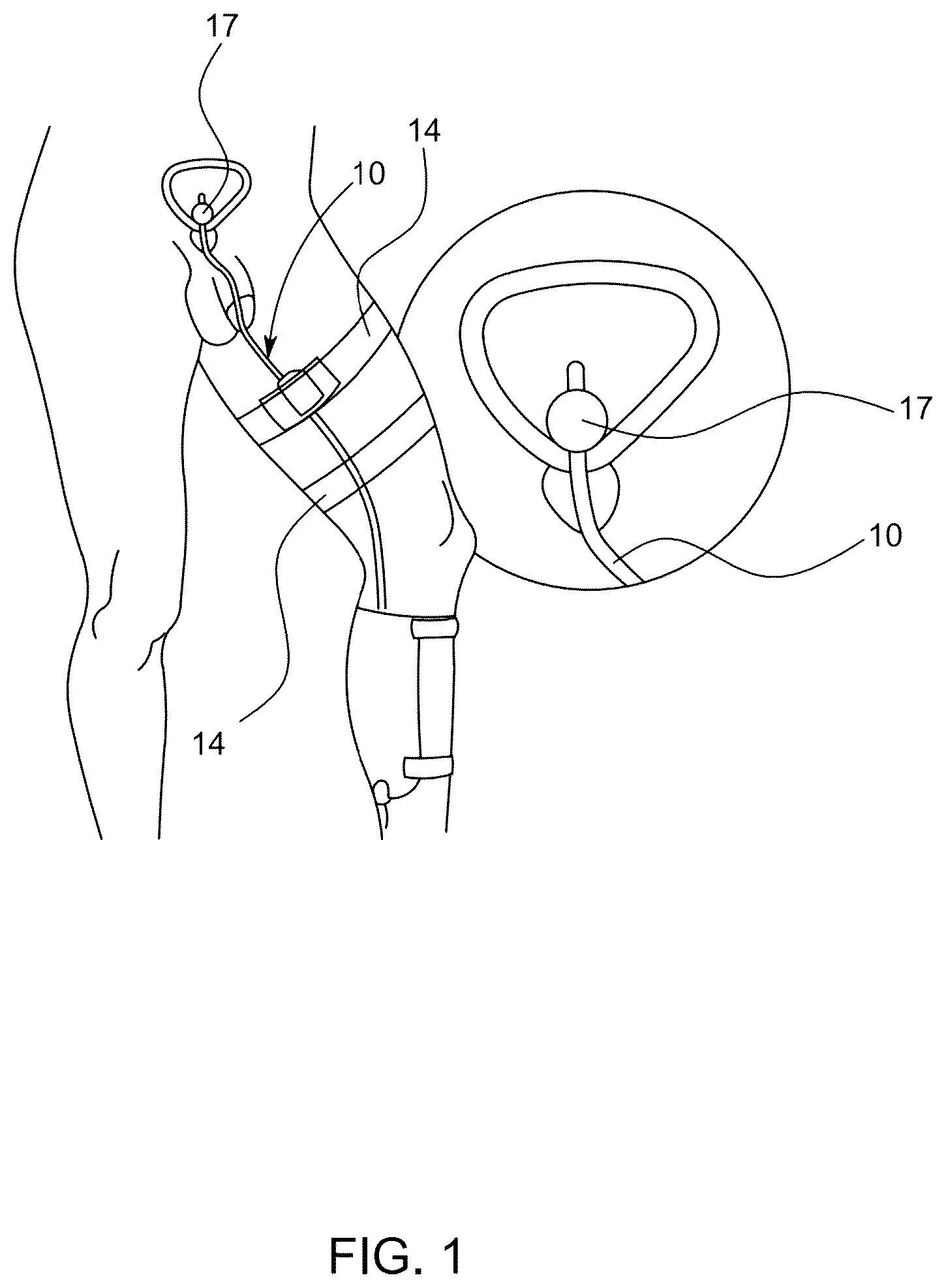 Patent US12311118 — Body fluid movement system — Figure 1