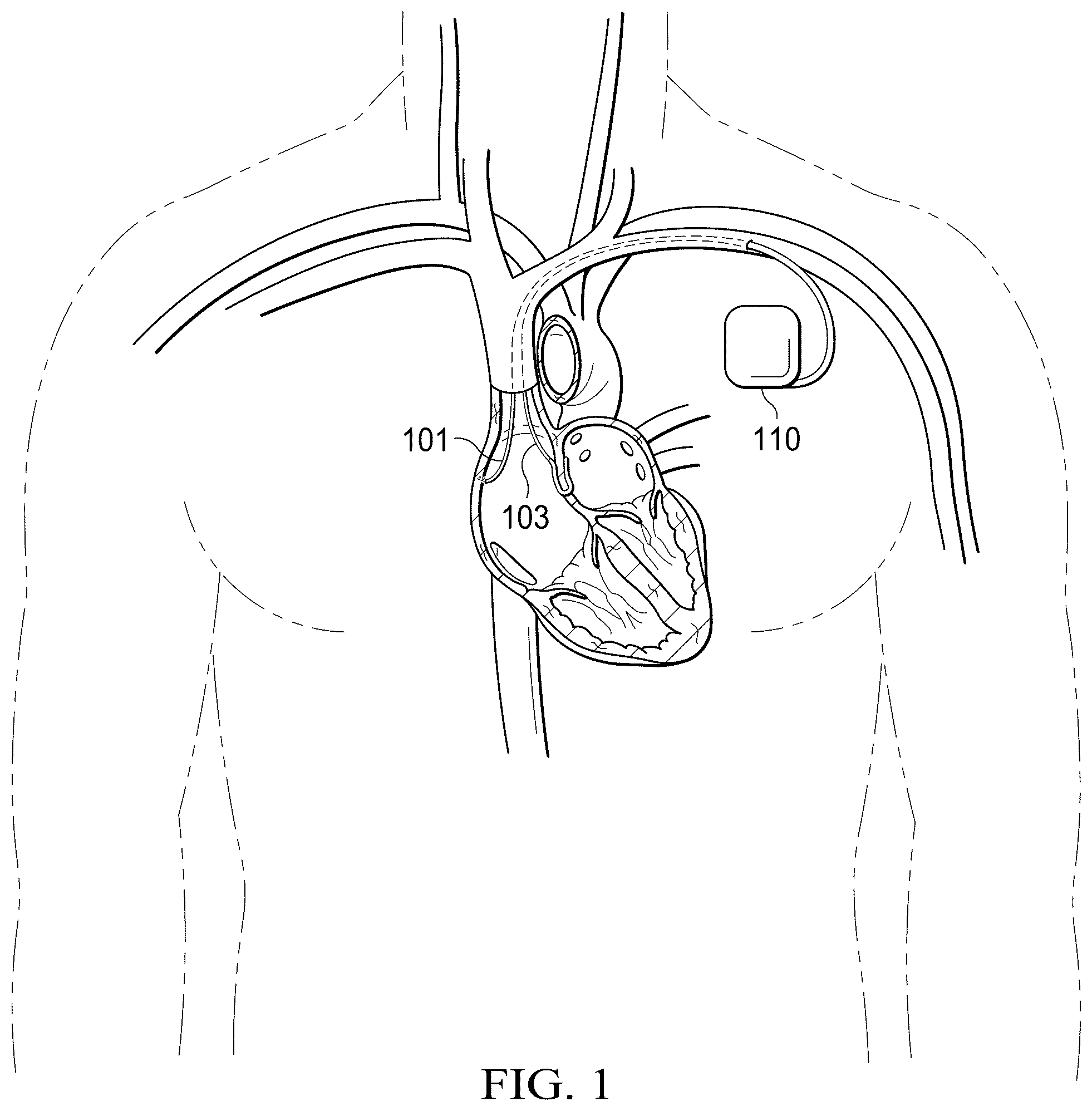 Patent US12311165 — Implantable endovascular, low profile intracardiac left atrial restraining devices for low energy atrial cardioversion, pacing and sensing — Figure 1