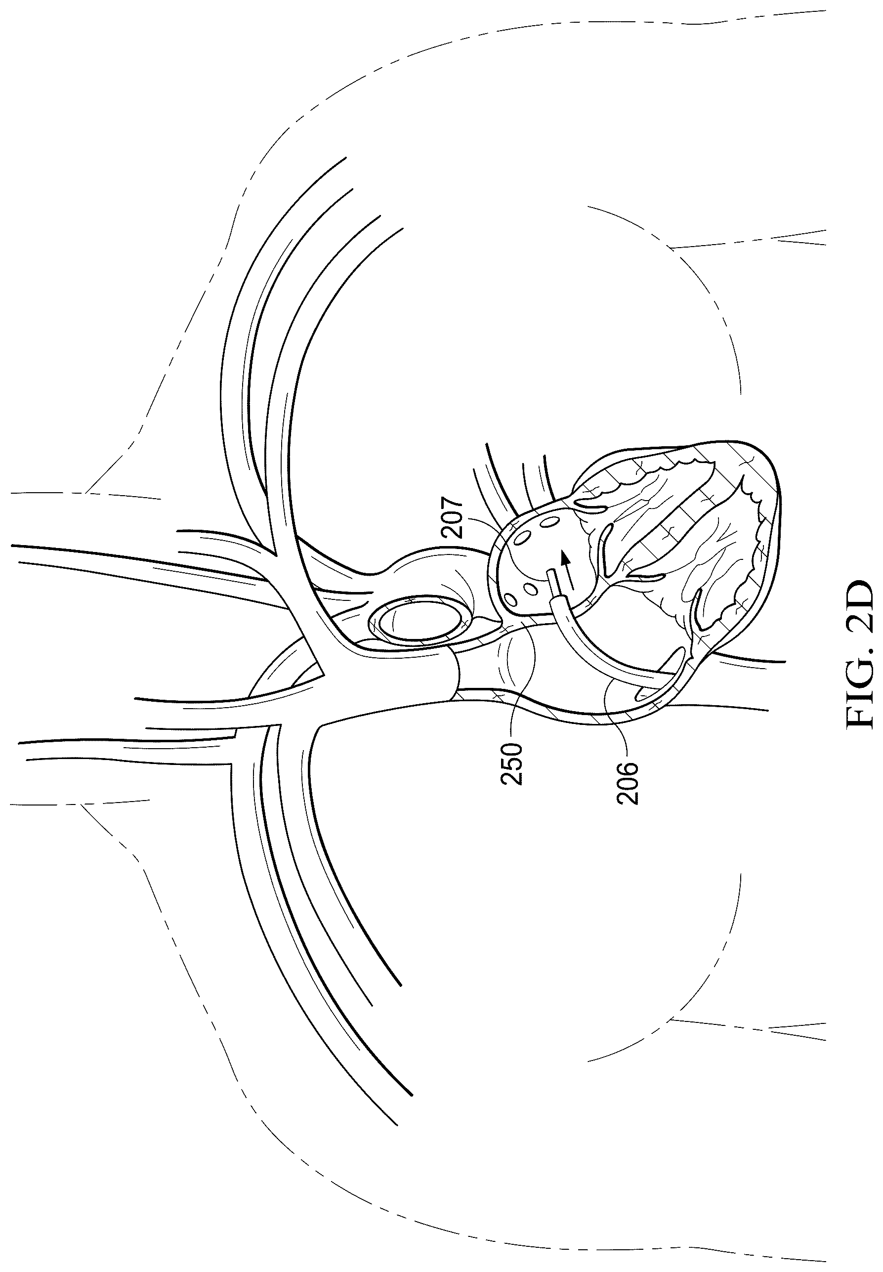 Patent US12311165 Figure 5 – Implantable endovascular, low profile intracardiac left atrial restraining devices for low energy atrial cardioversion, pacing and sensing