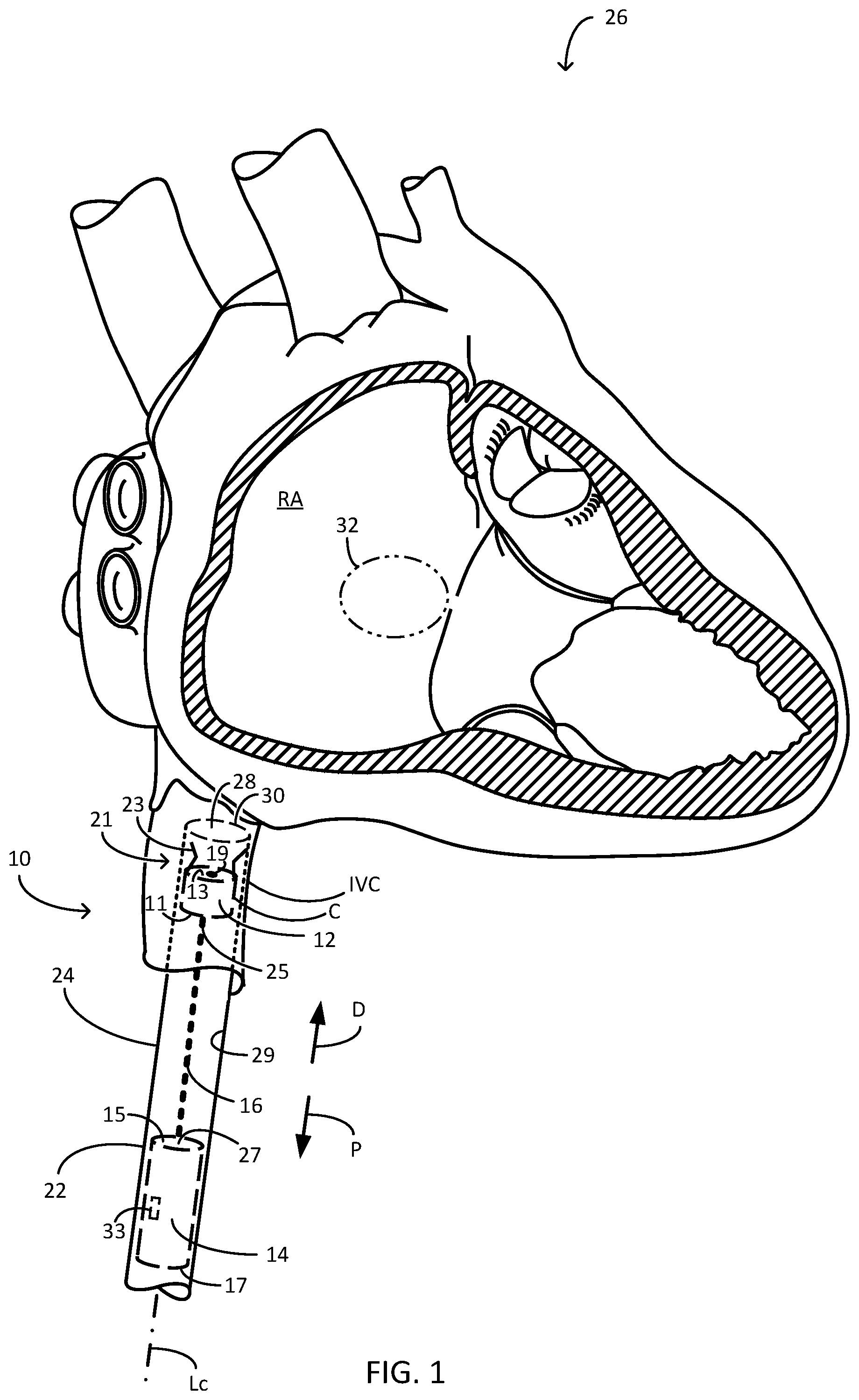 Patent US12311166 — Implantable medical system — Figure 1
