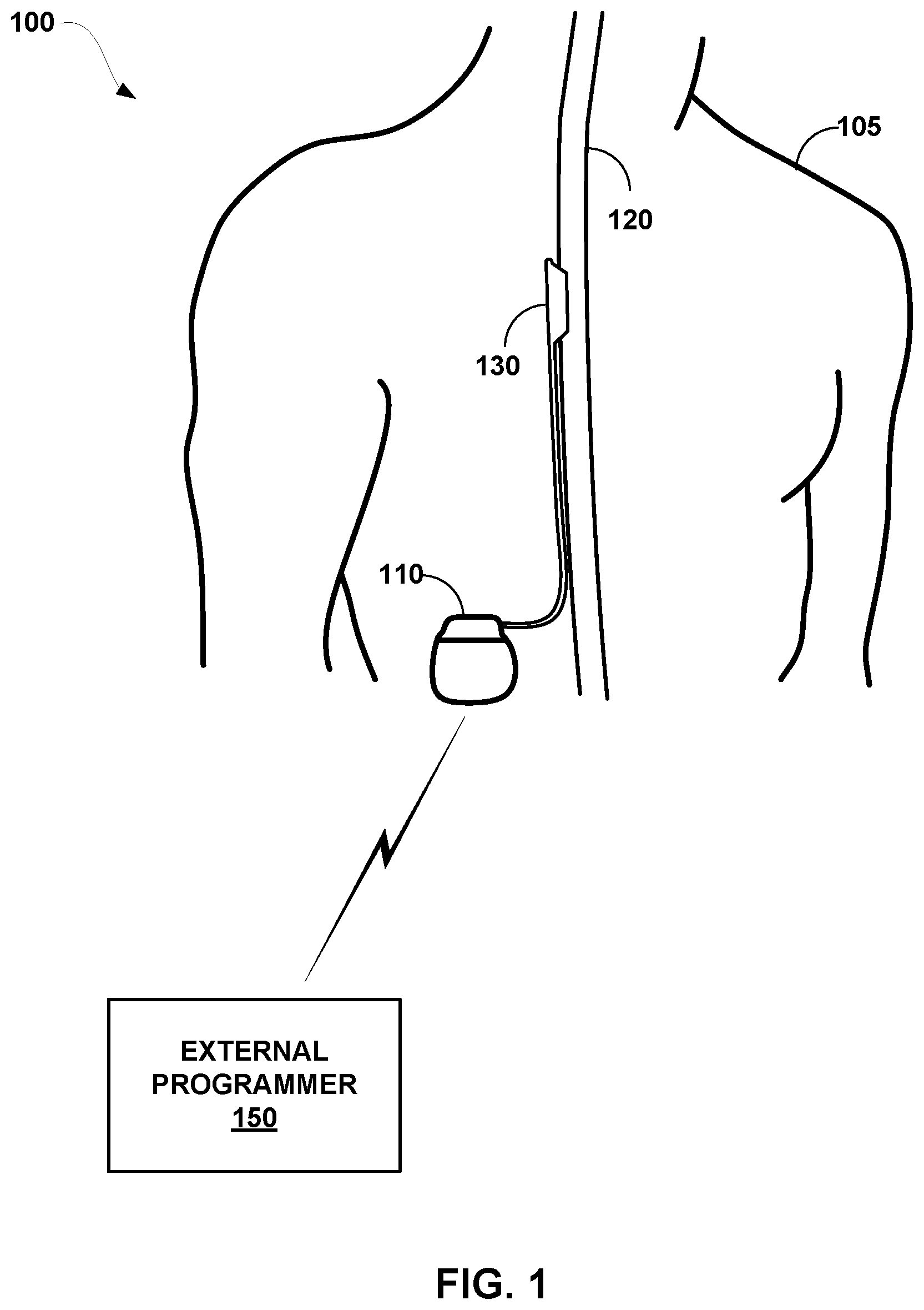 Patent US12311176 — Implantable lead location using ECAP — Figure 1