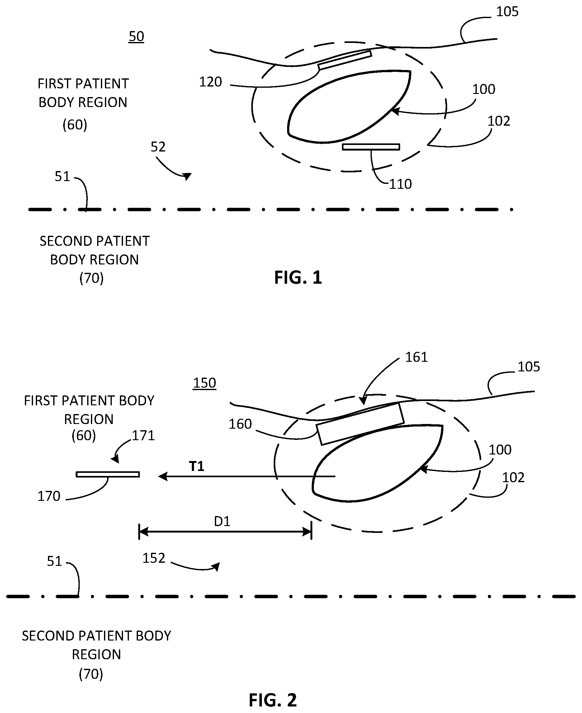 Patent US12311179 — Implant-access incision and sensing for sleep disordered breathing (SDB) care — Figure 1