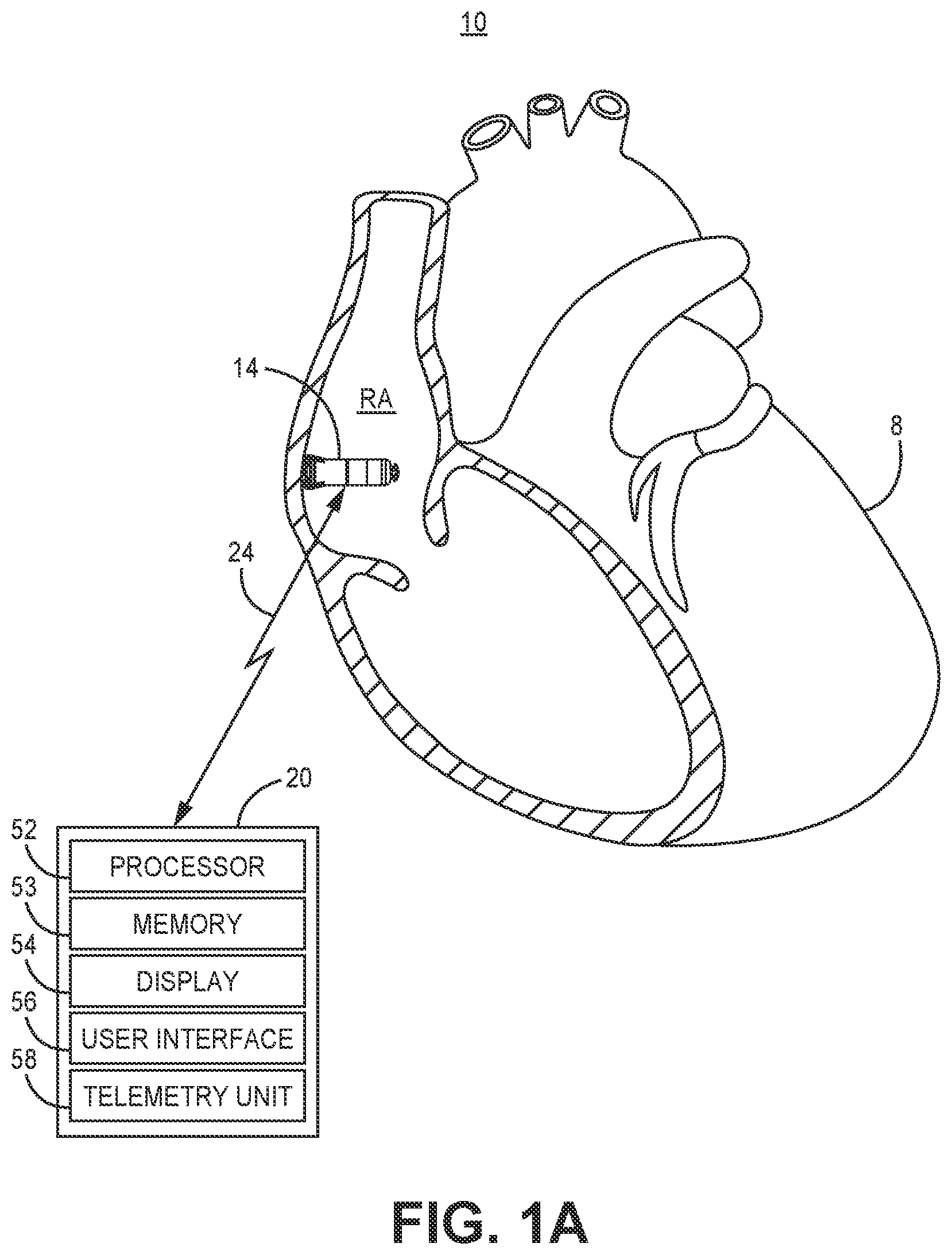 Patent US12311182 — Device and method for atrial tachyarrhythmia detection — Figure 1