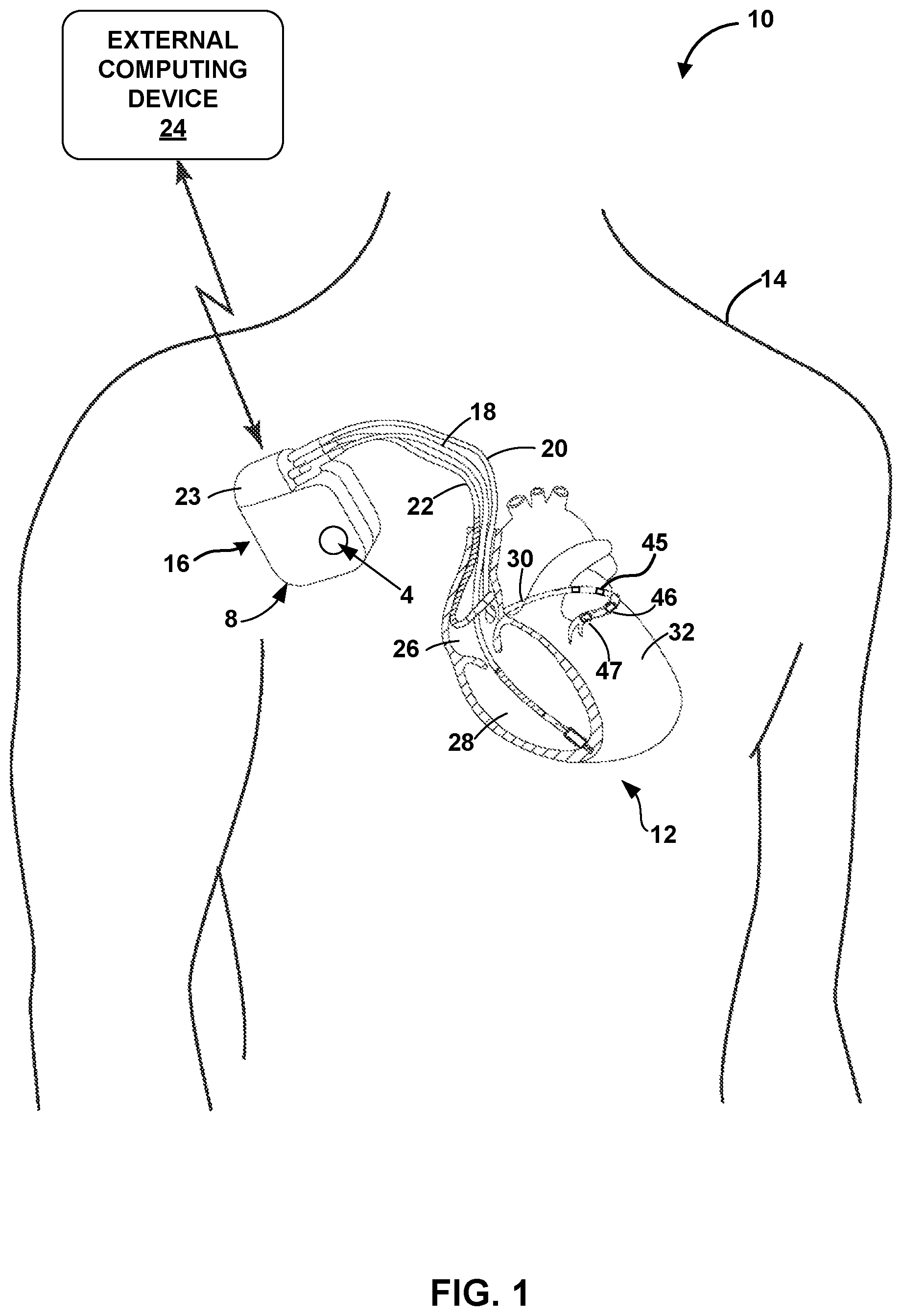 Patent US12311183 Figure 1 – Current steering for cardiac pacing