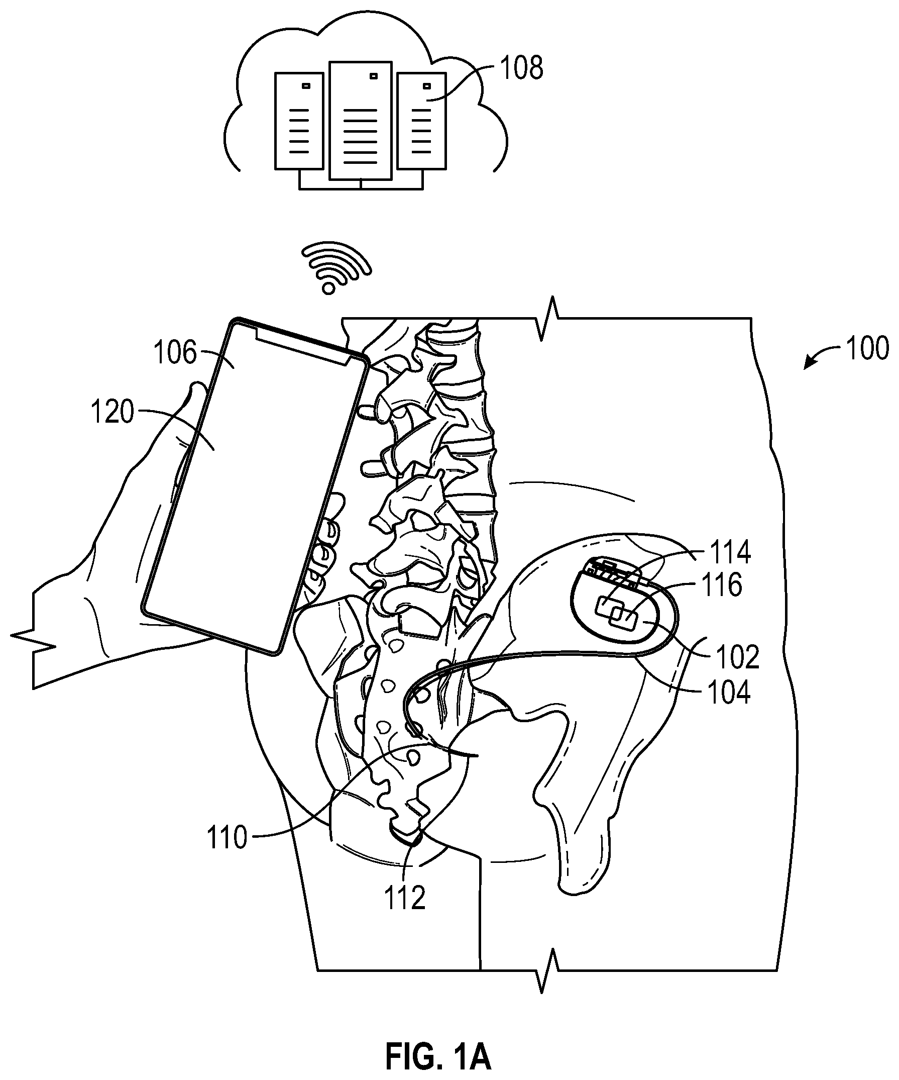 Patent US12311184 — Method and user interface for managing duty-cycled electrical nerve stimulation — Figure 1