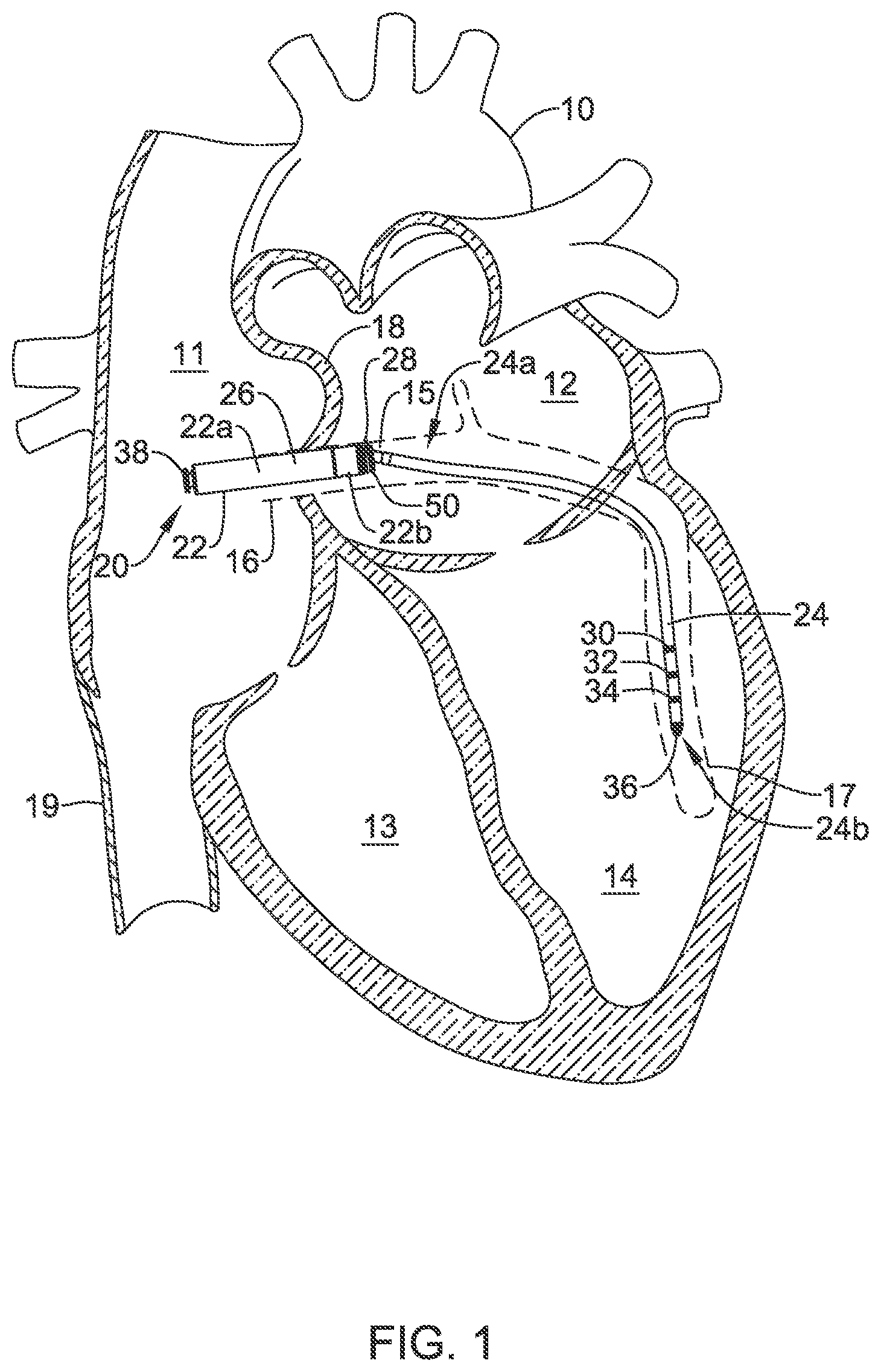 Patent US12311186 — Systems and methods for treating cardiac arrhythmias — Figure 1