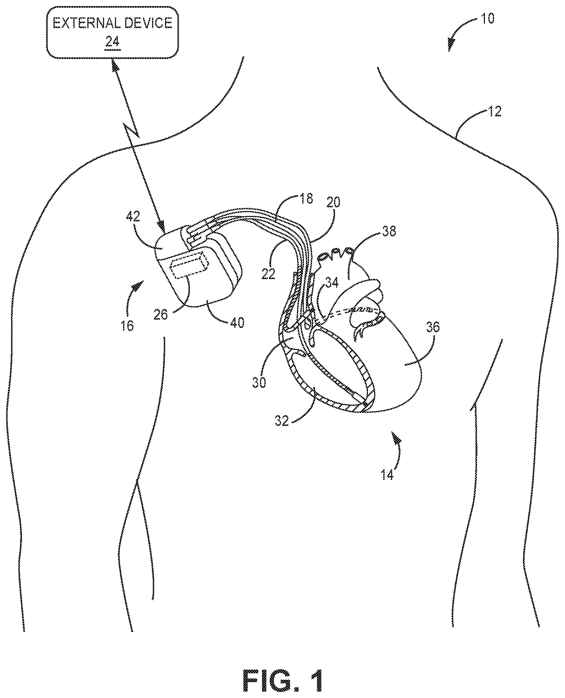 Patent US12311187 — Battery assembly for medical device — Figure 1