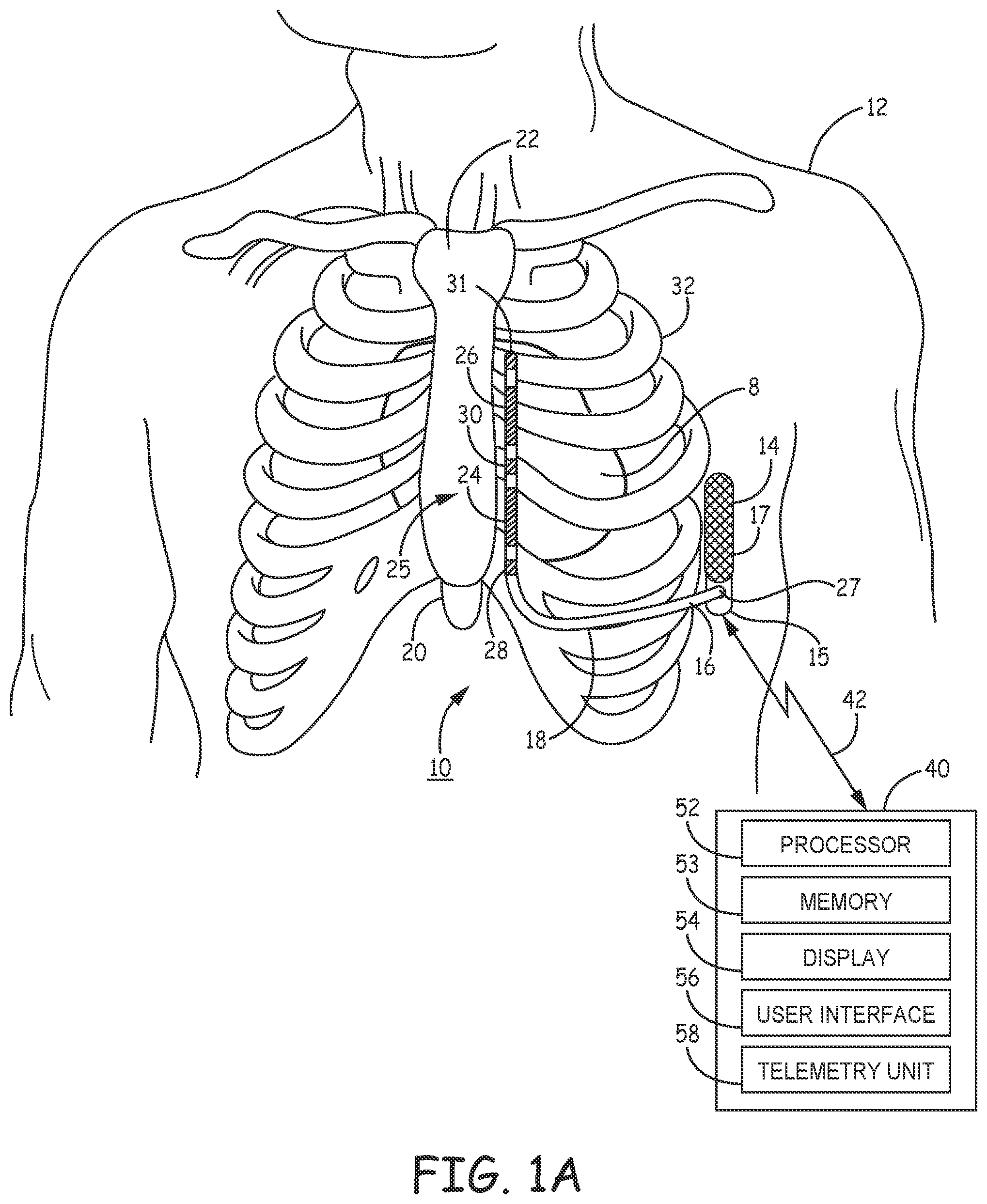 Patent US12311189 — Multi-threshold sensing of cardiac electrical signals in an extracardiovascular implantable cardioverter defibrillator — Figure 1