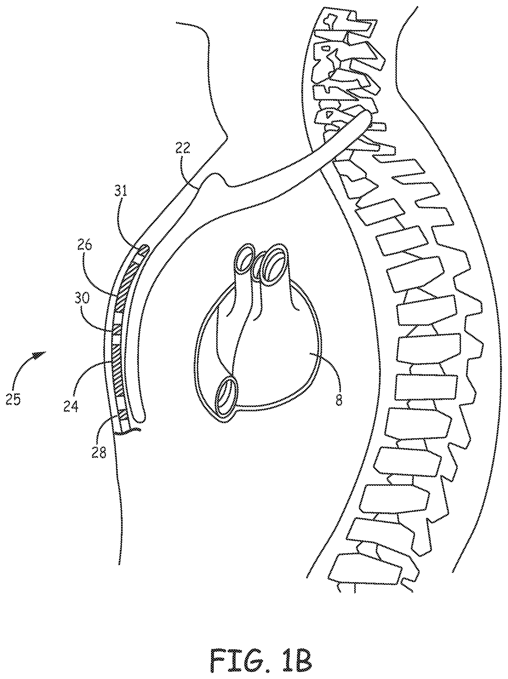 Patent US12311189 Figure 2 – Multi-threshold sensing of cardiac electrical signals in an extracardiovascular implantable cardioverter defibrillator