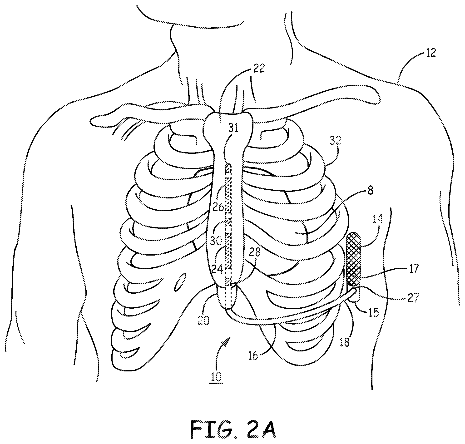 Patent US12311189 Figure 3 – Multi-threshold sensing of cardiac electrical signals in an extracardiovascular implantable cardioverter defibrillator