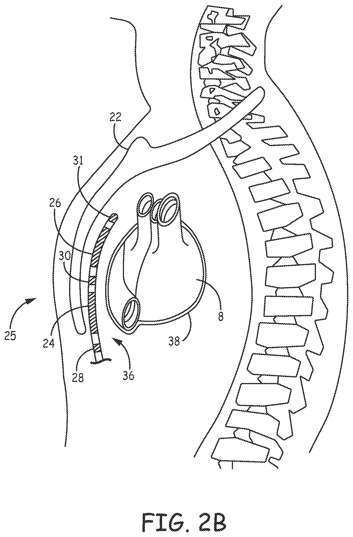 Patent US12311189 Figure 4 – Multi-threshold sensing of cardiac electrical signals in an extracardiovascular implantable cardioverter defibrillator